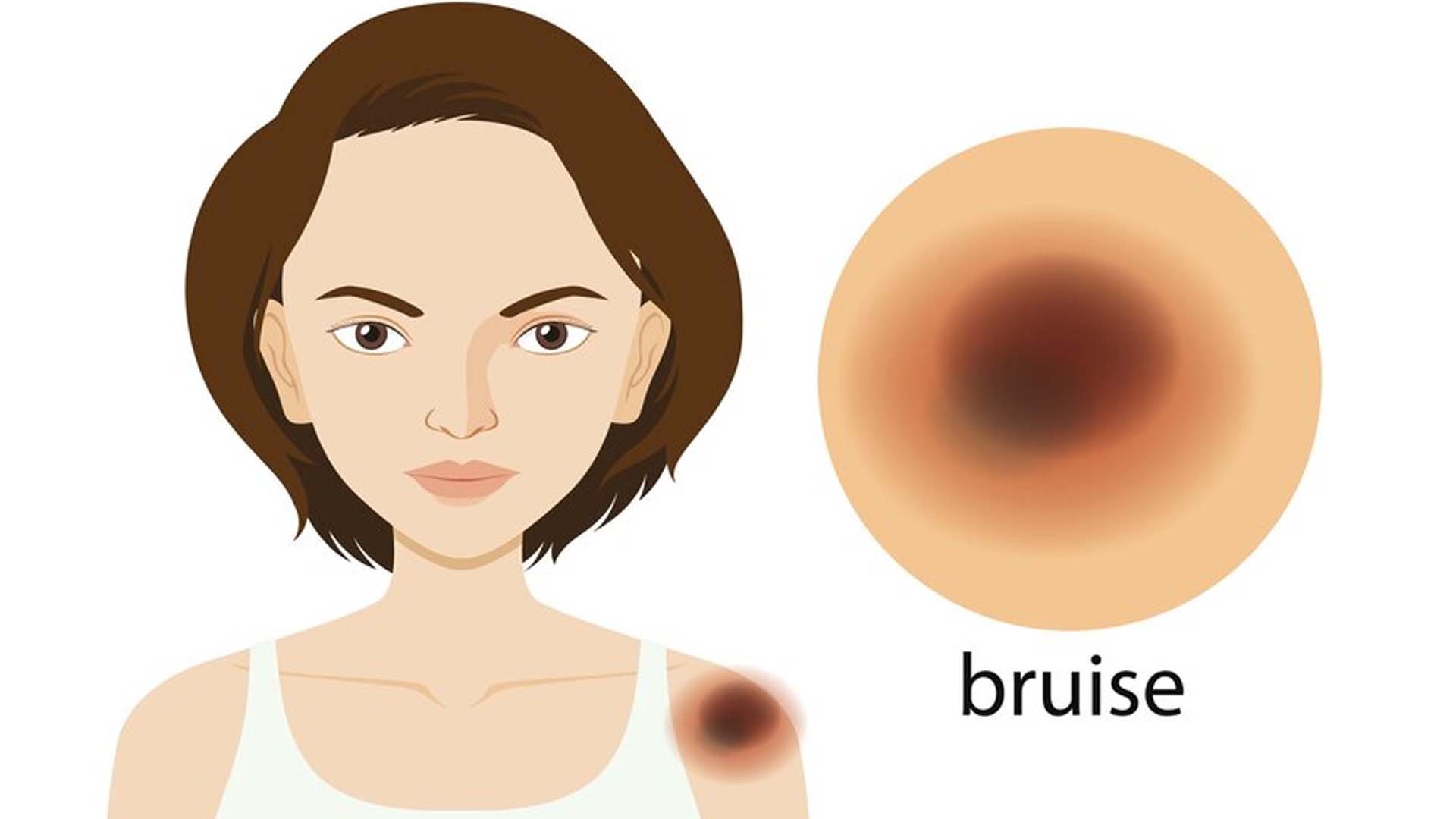 Unexplained Bruising