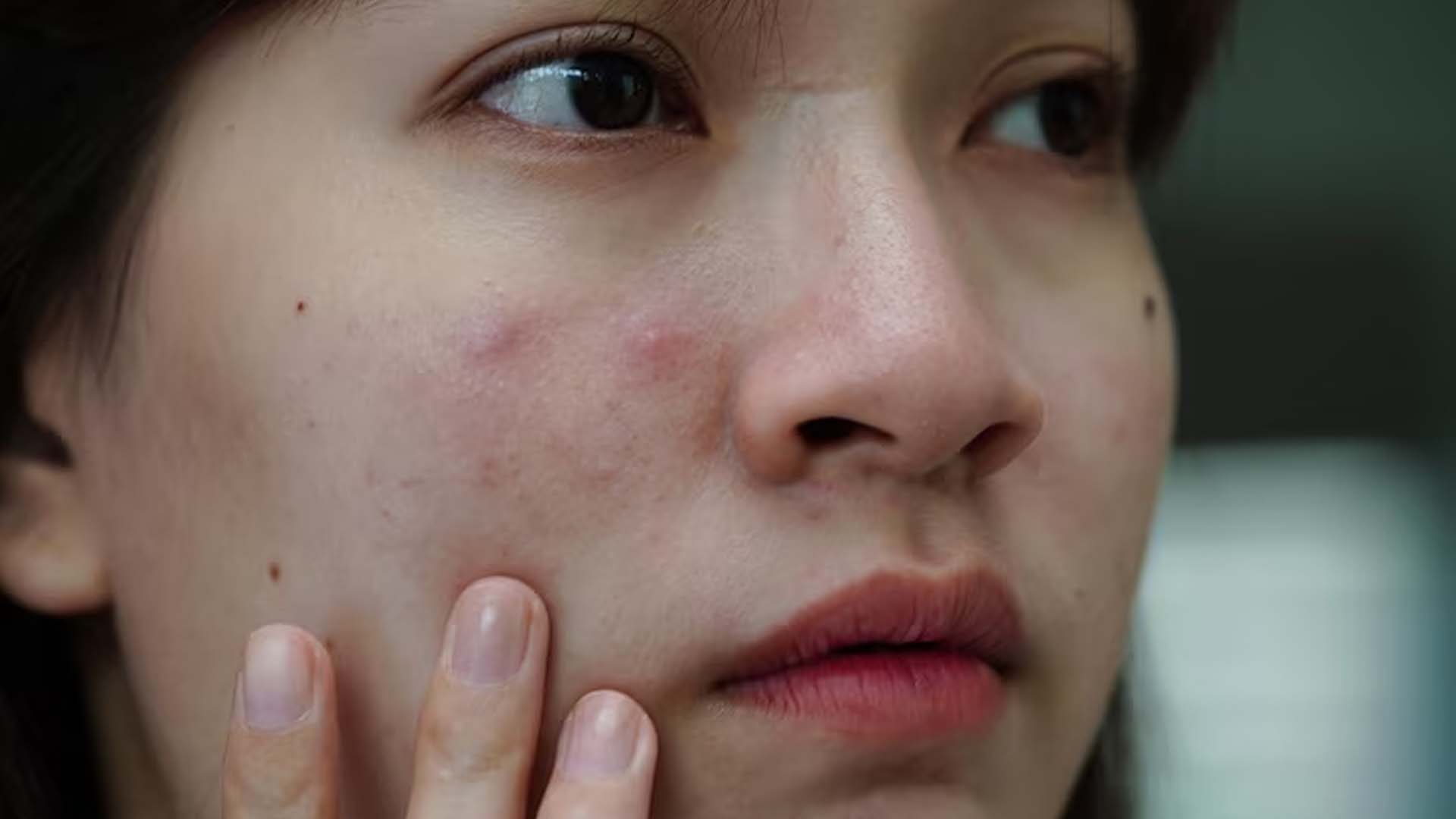 Bumps on the face or Acne