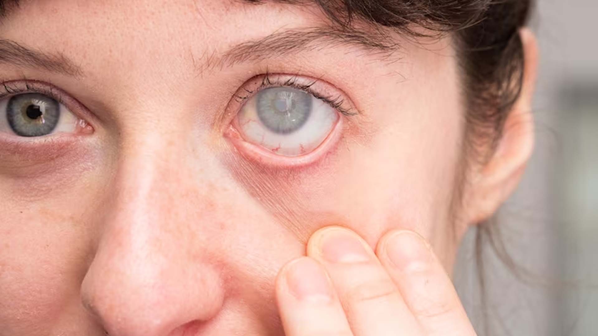 Kid With Cataracts
