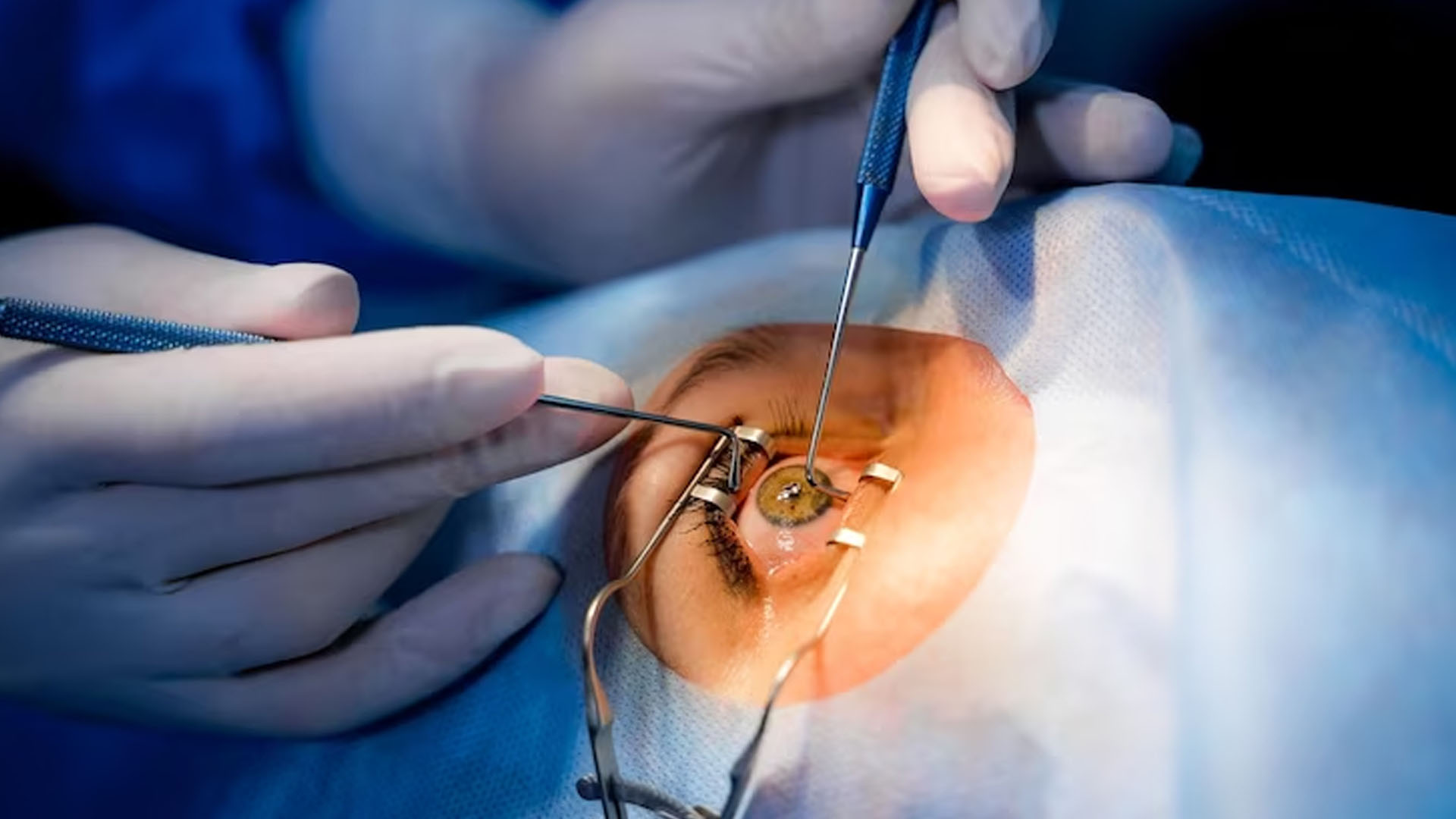 What are the Symptoms of Posterior Capsule Opacification?