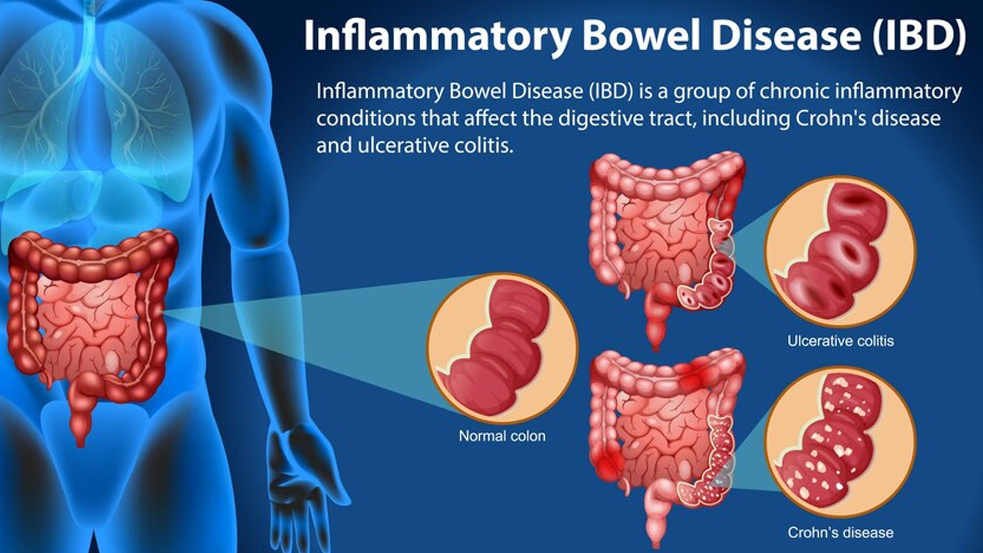 What are the Symptoms of Chrome Disease?