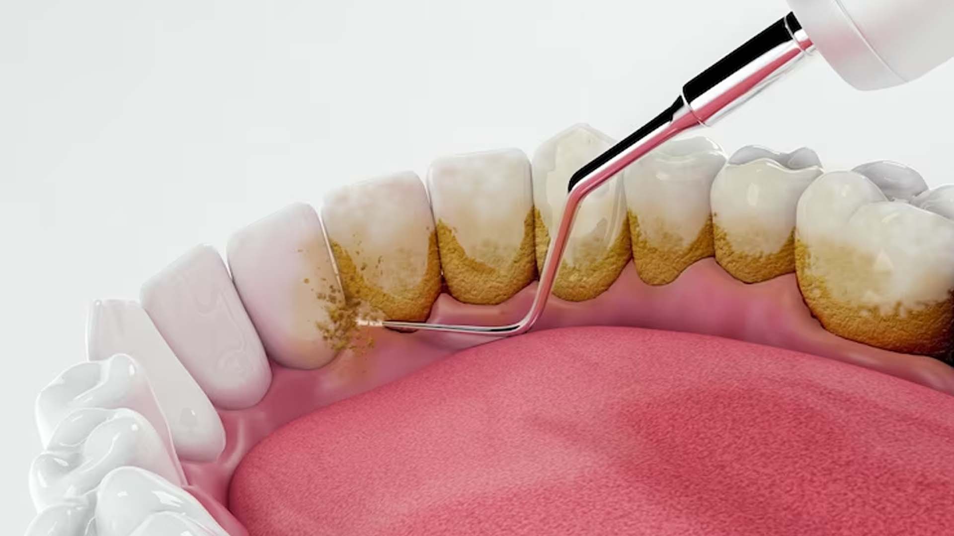 Tartar or Dental calculus or Plaque