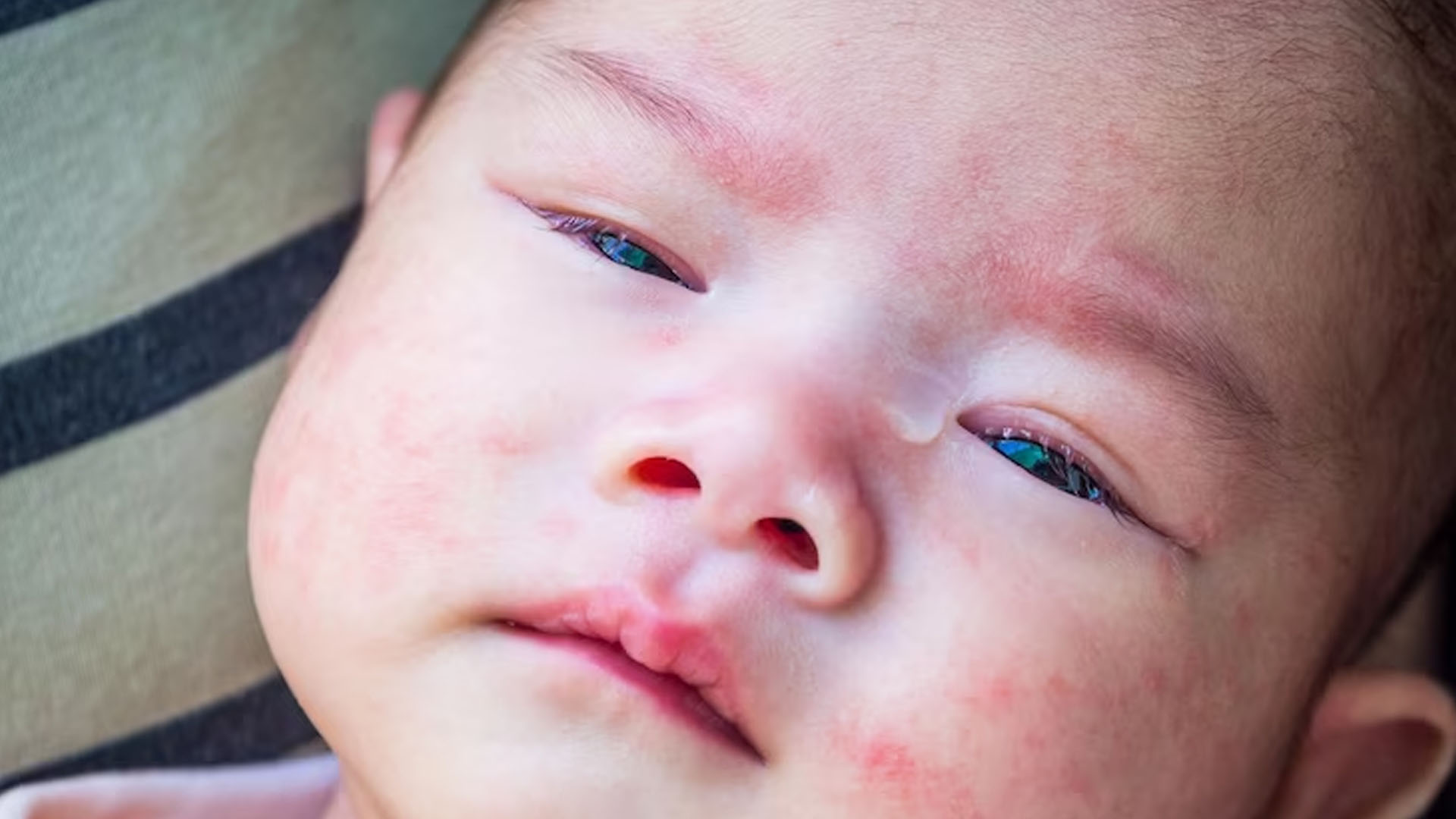 What are the Symptoms of Conjunctivitis in Babies?