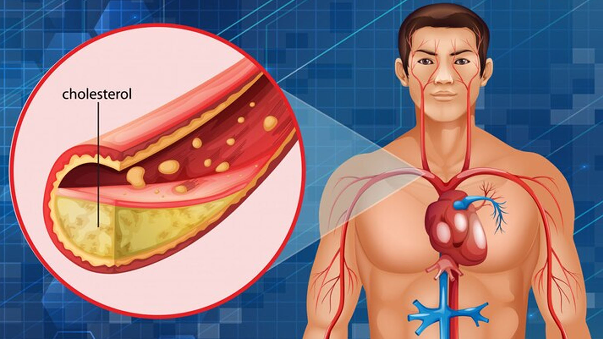 What are the Symptoms of Coronary Artery Disease?