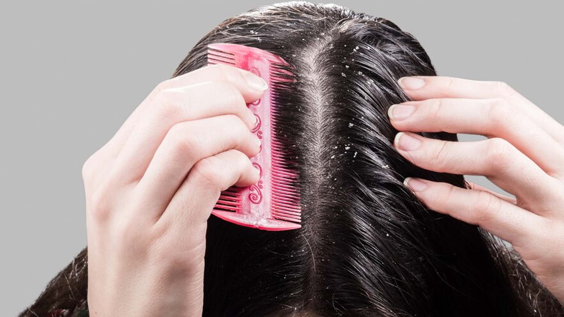 Dandruff in Women's Scalps