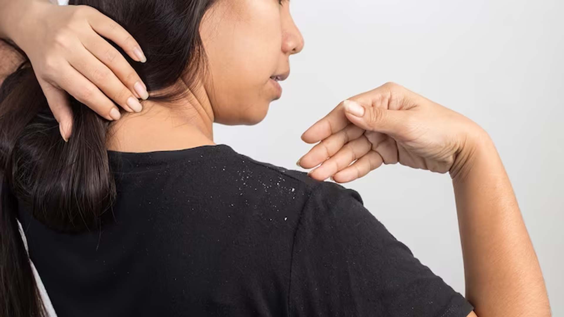 Dandruff on Women Shoulder