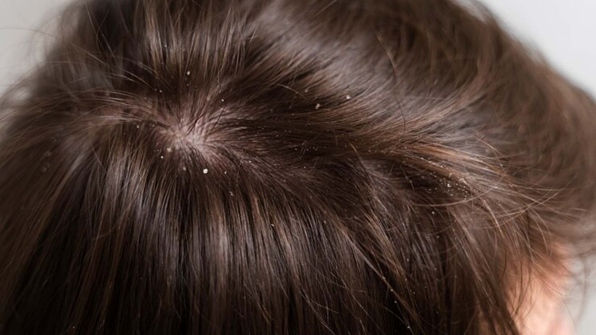 Man with Dandruff