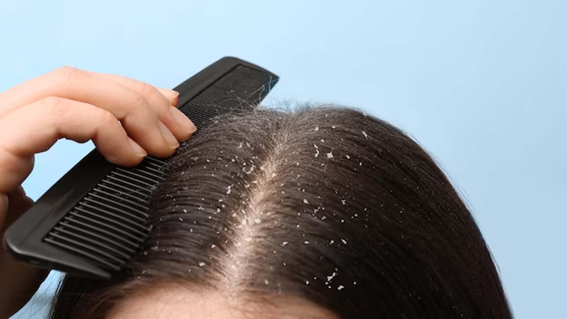 Dandruff in Women Hair