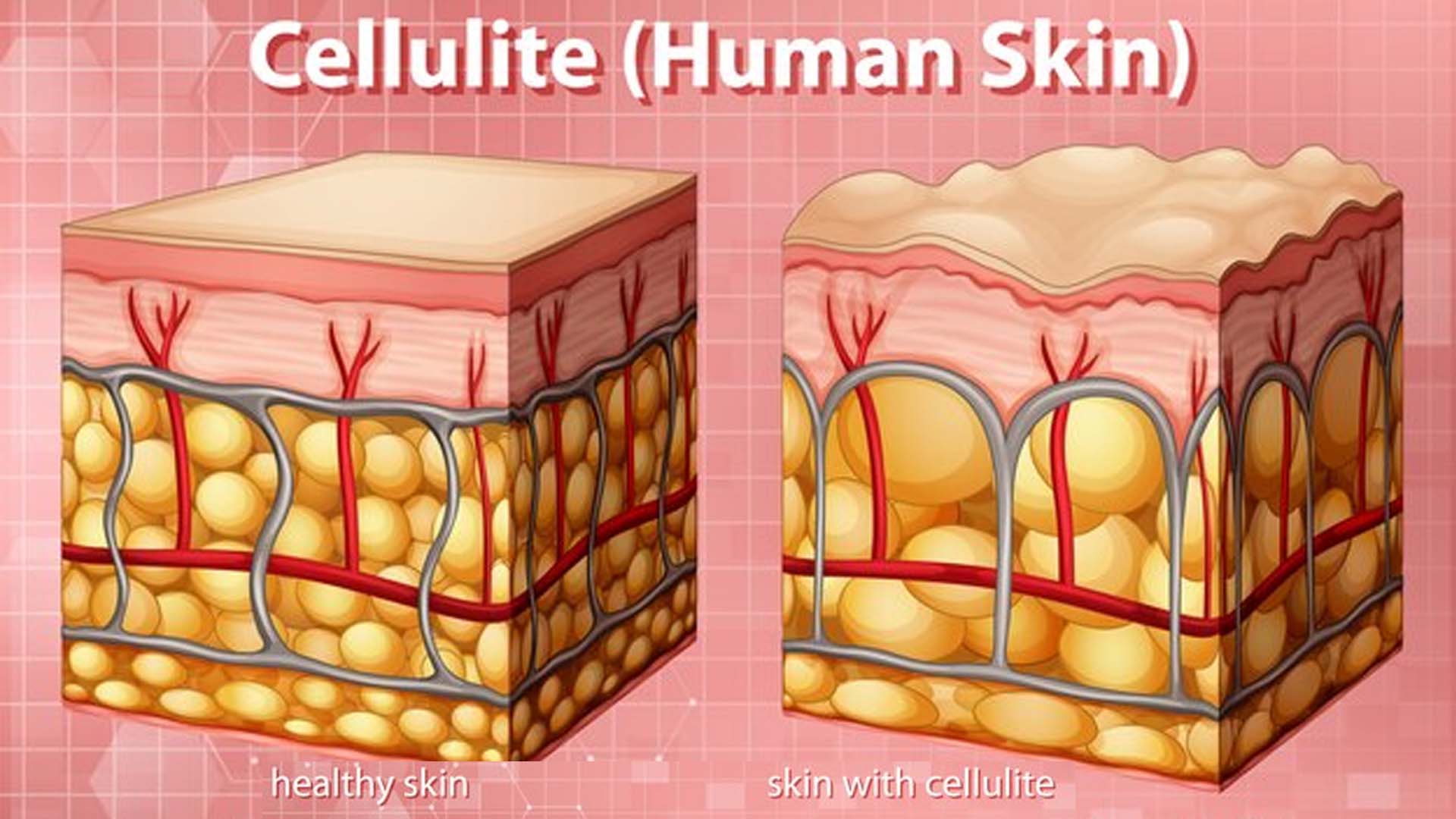 Cellulitis Diagram