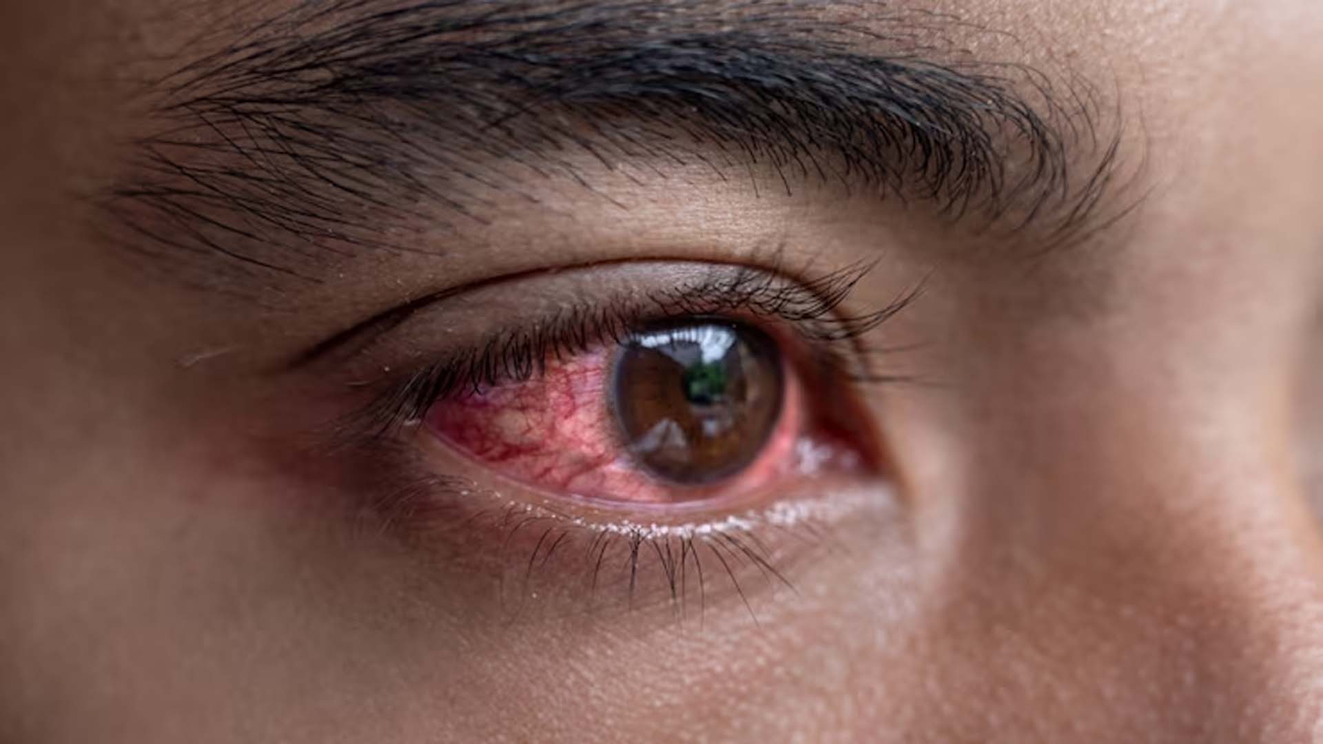 Dry Eyes
