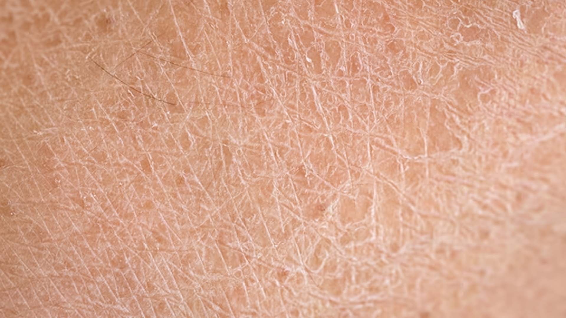 Dry Skin