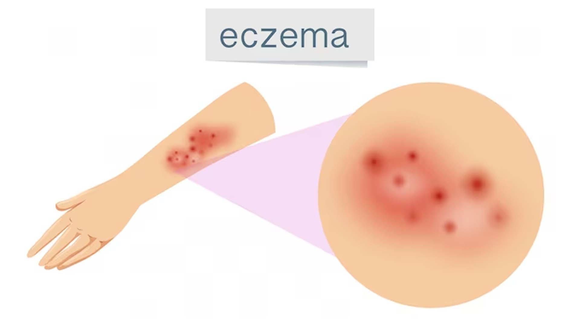 Eczema or Atopic dermatitis