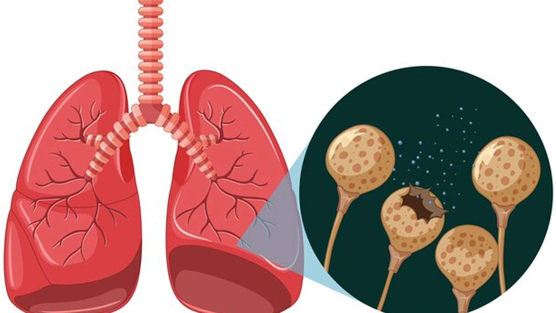 What are the Symptoms of Emphysema?