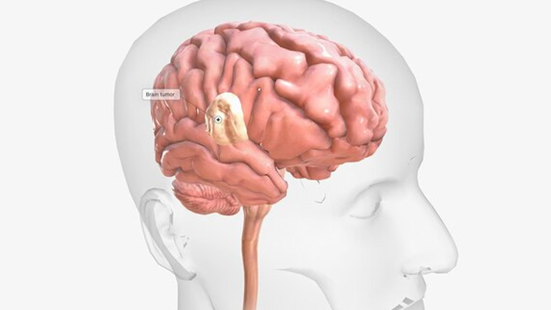 What are the Symptoms and Treatment of Japanese Encephalitis?
