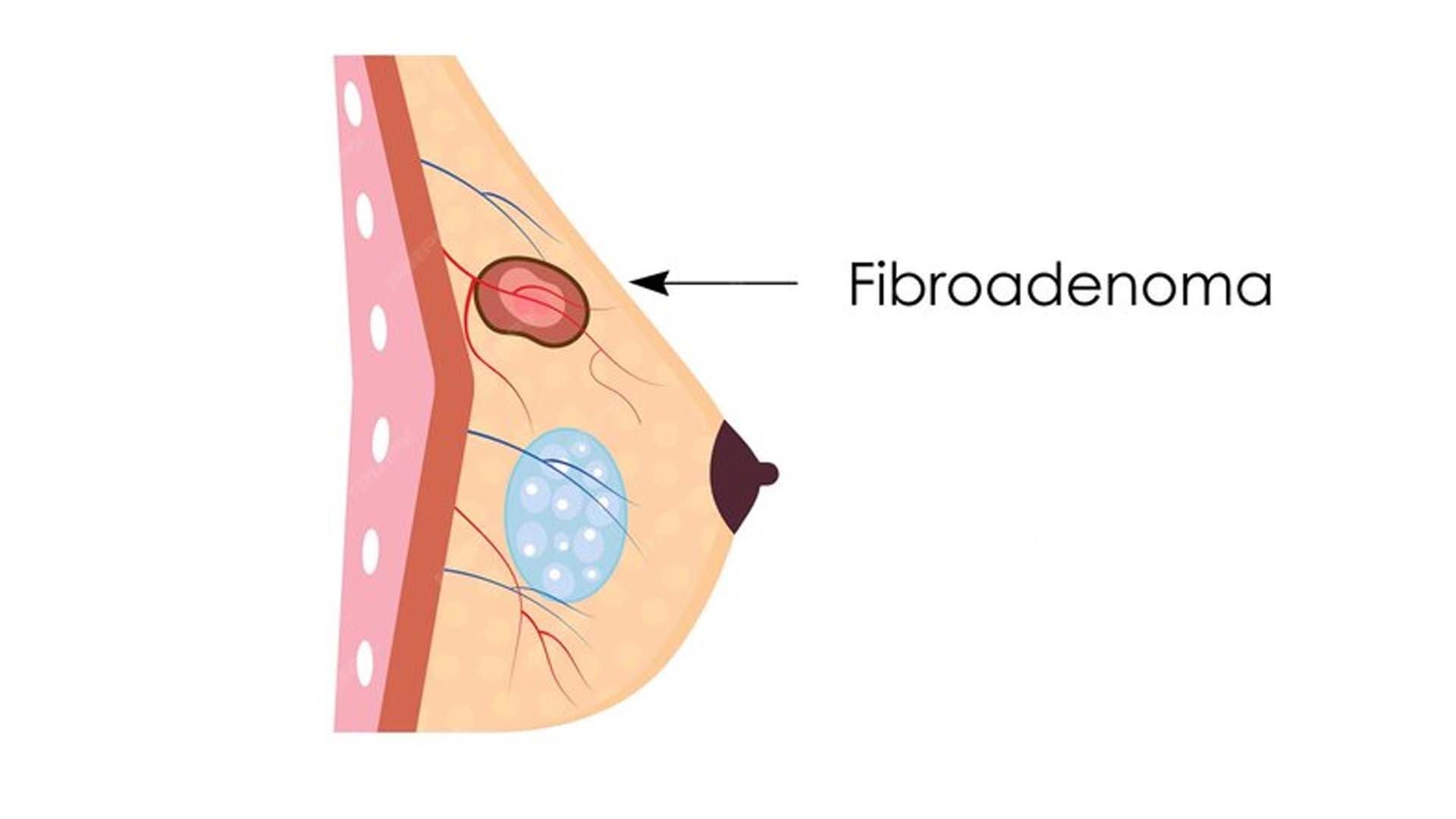 Fibroadenoma illustration