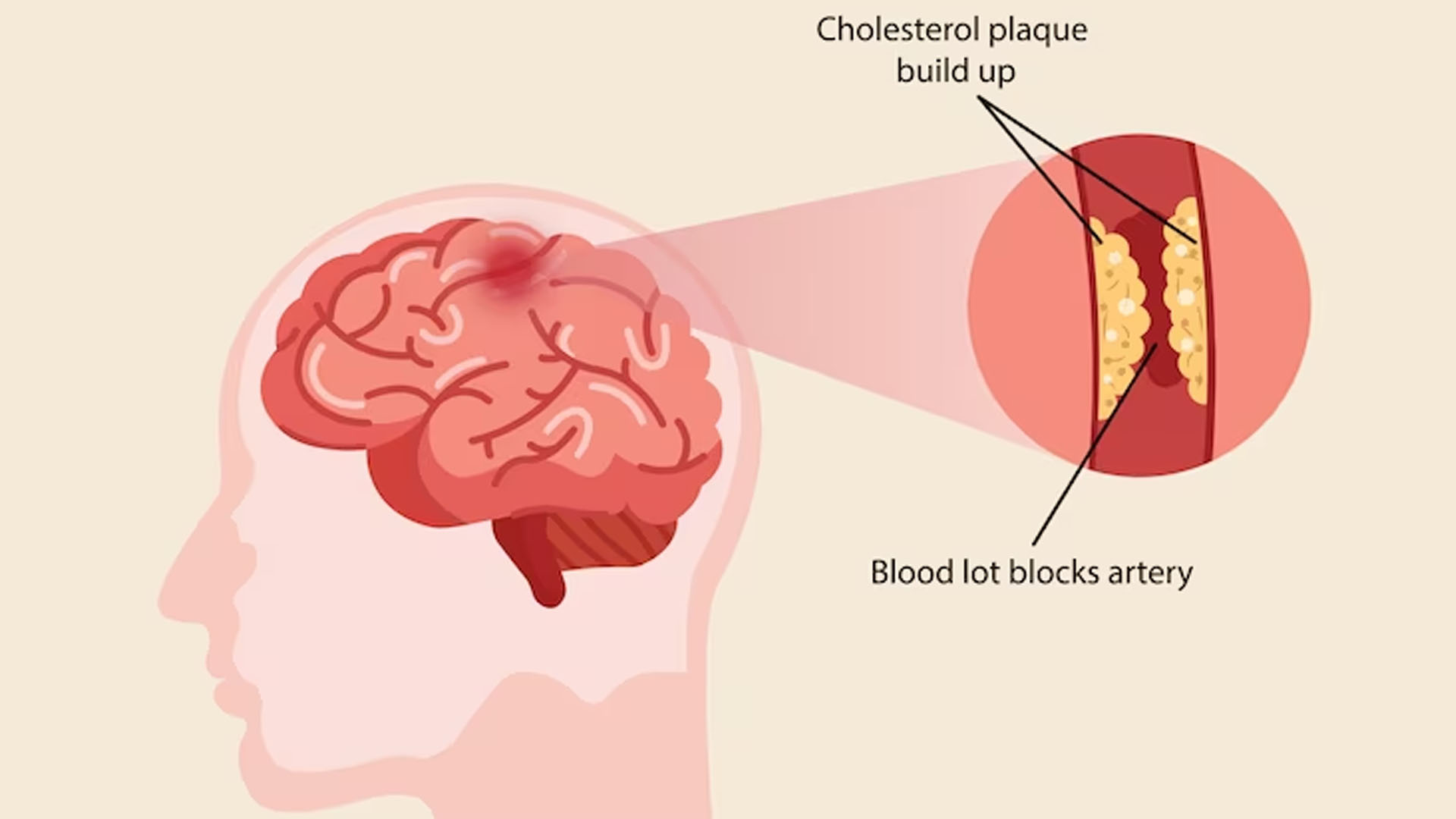What are the Symptoms of Frontal Lobe Damage?
