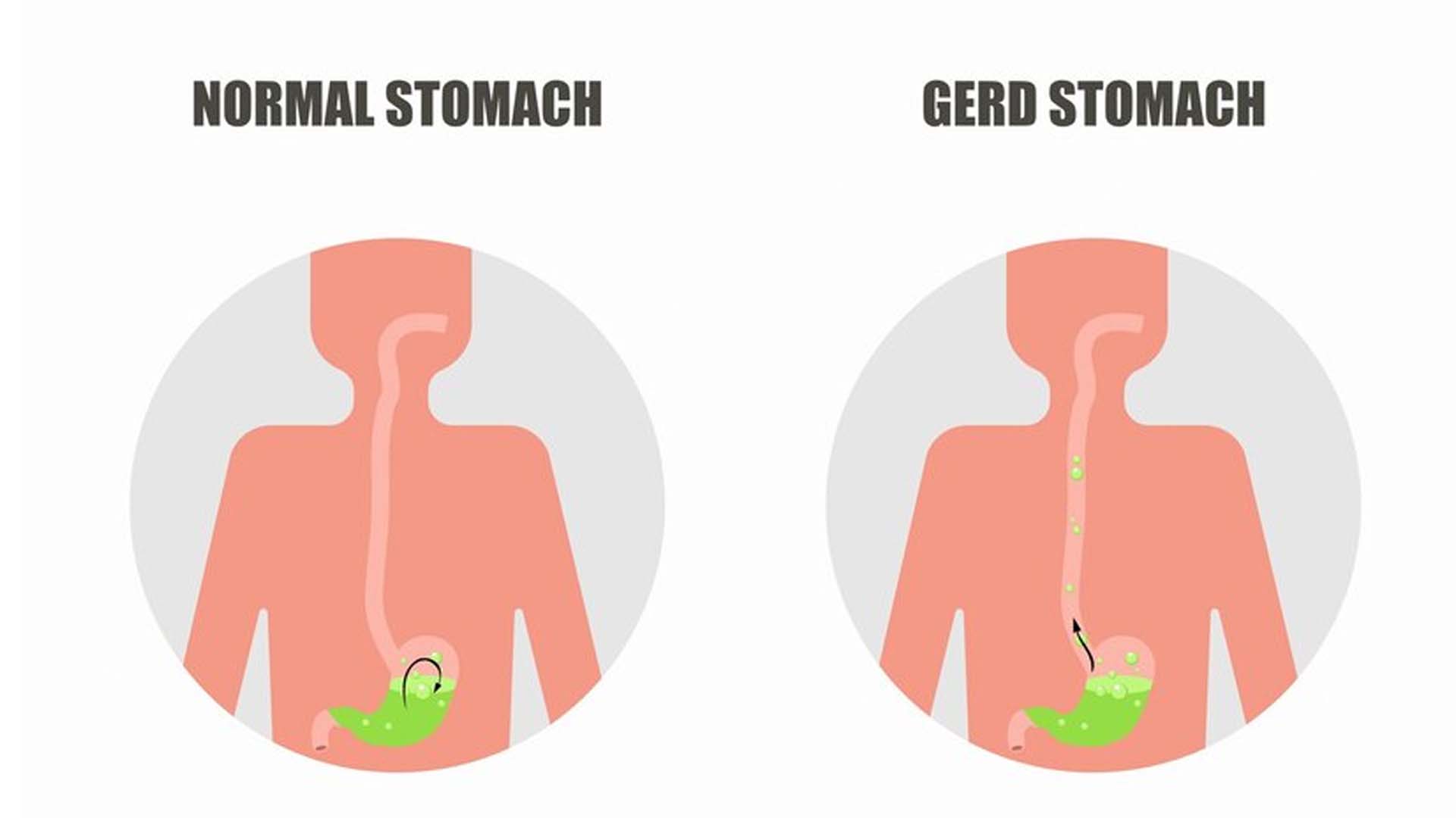 Gastroesophageal Reflux Disease (GERD)
