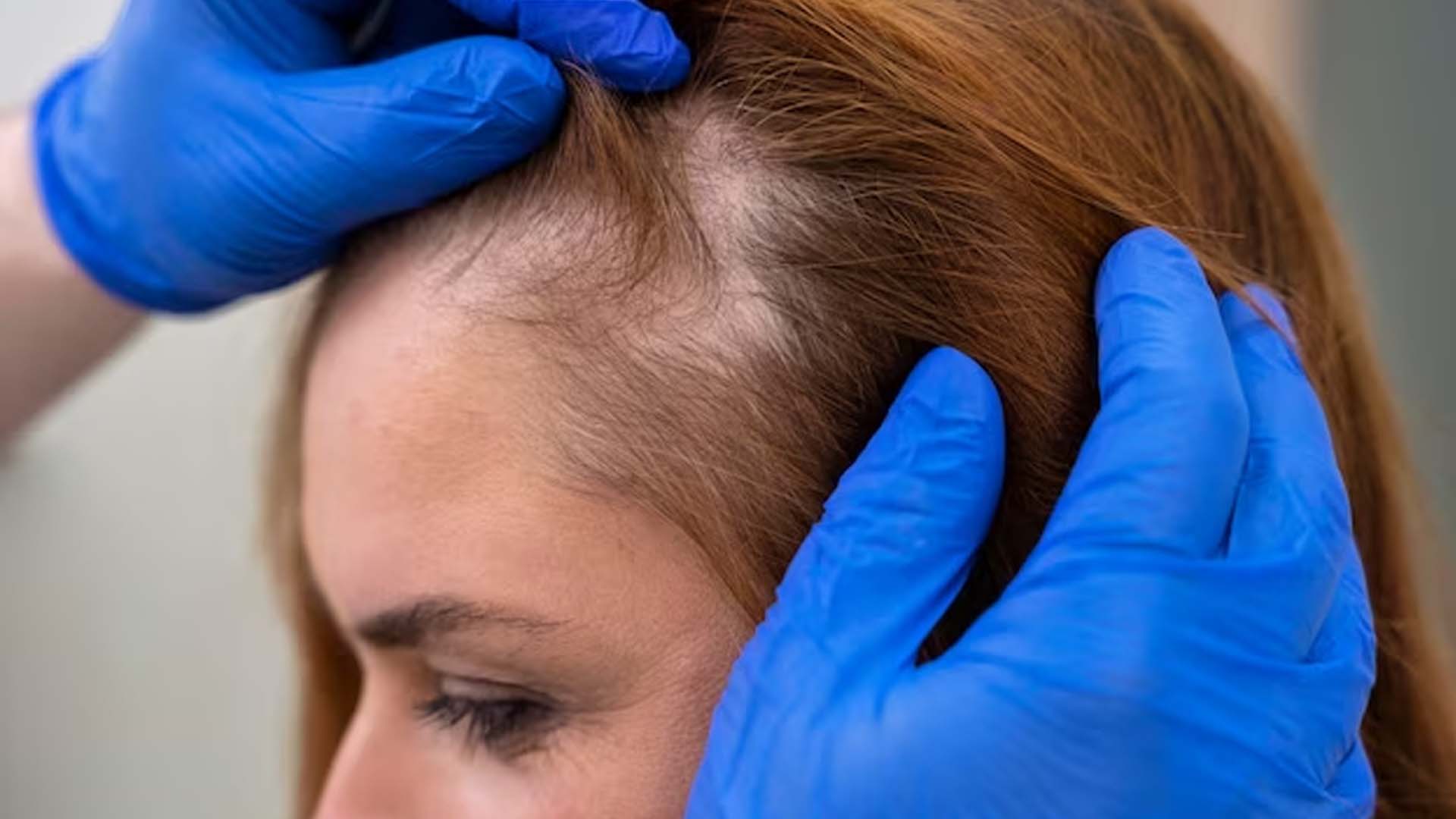 Hair Loss in Women