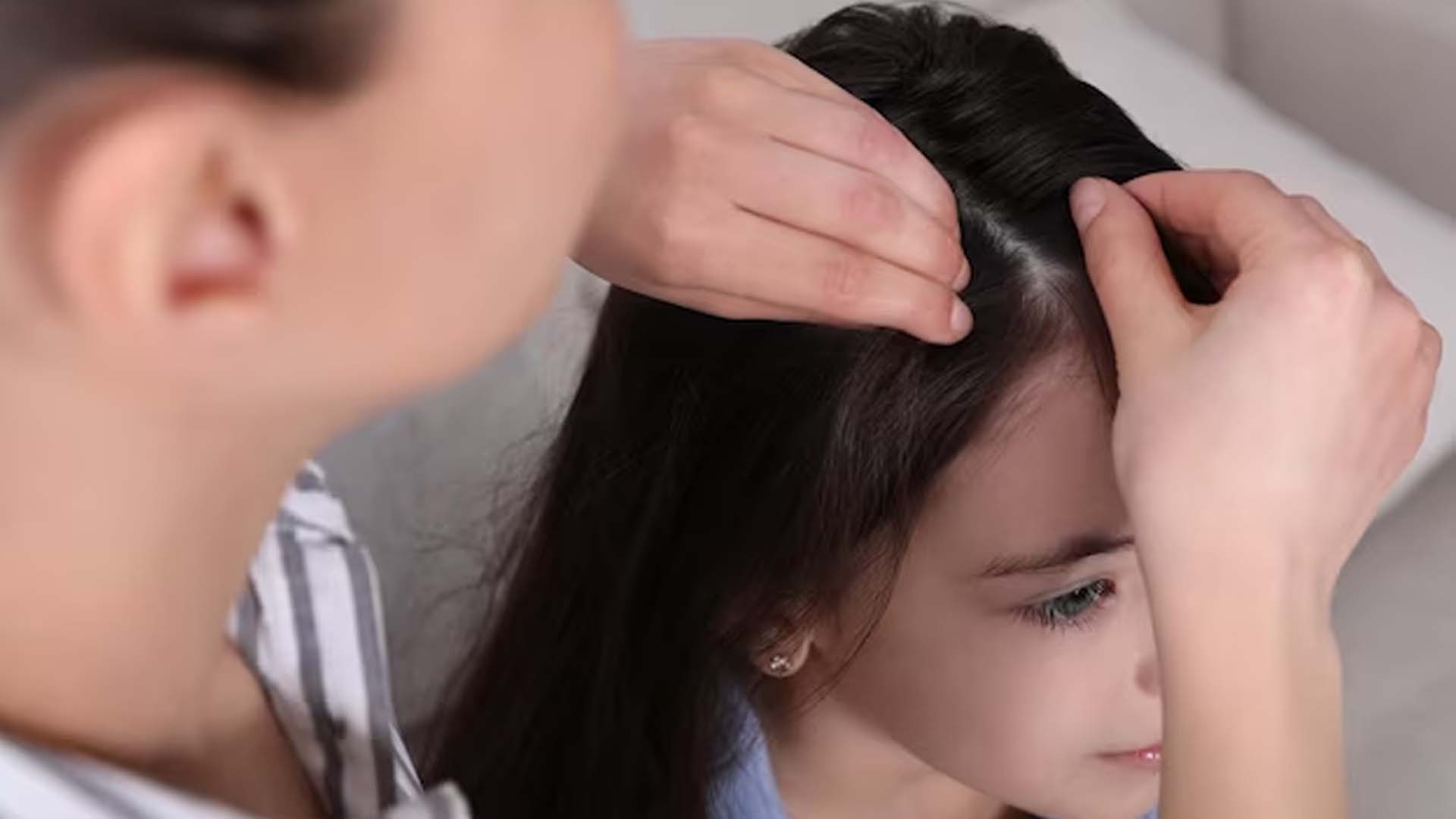 Hair loss in children