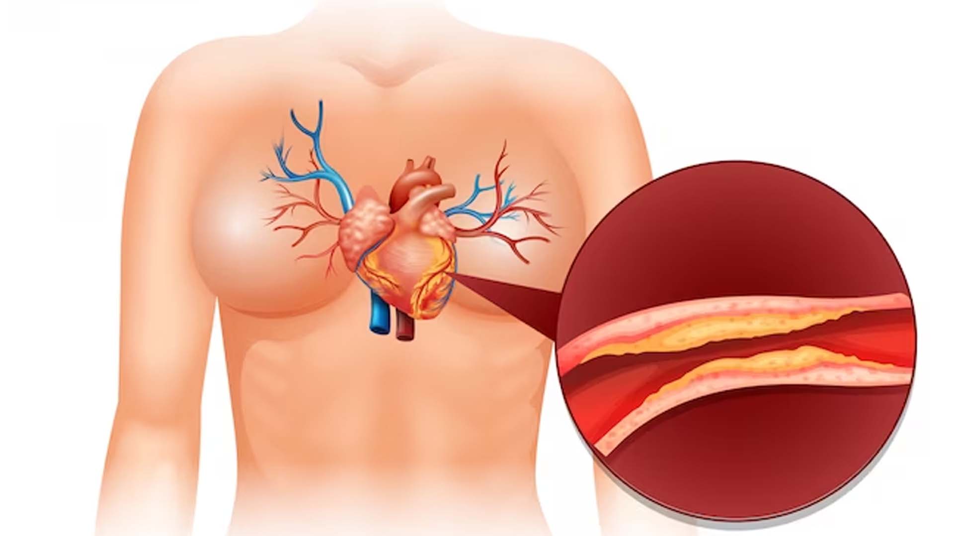 Cholesterol in Heart