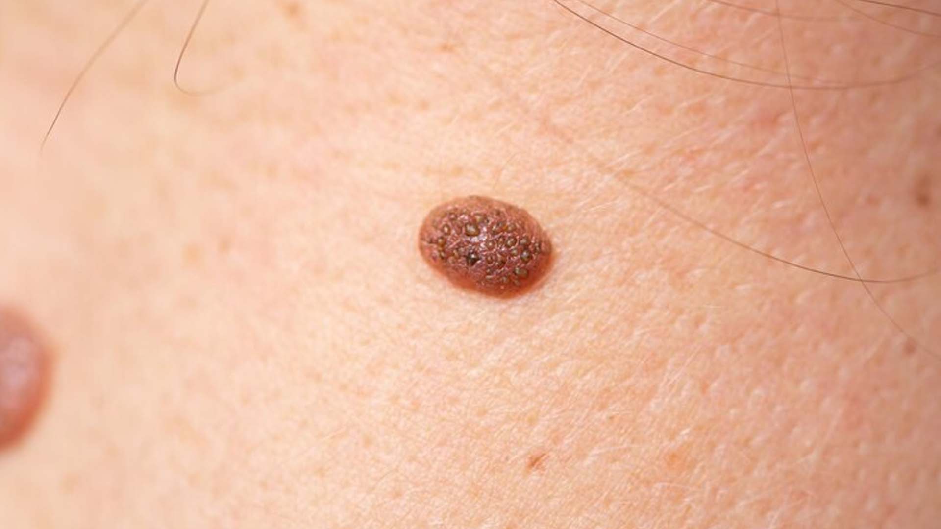 Hemangioma or birth mark