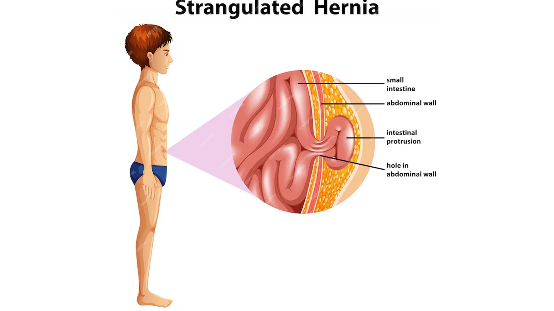 Strangulated Hernia