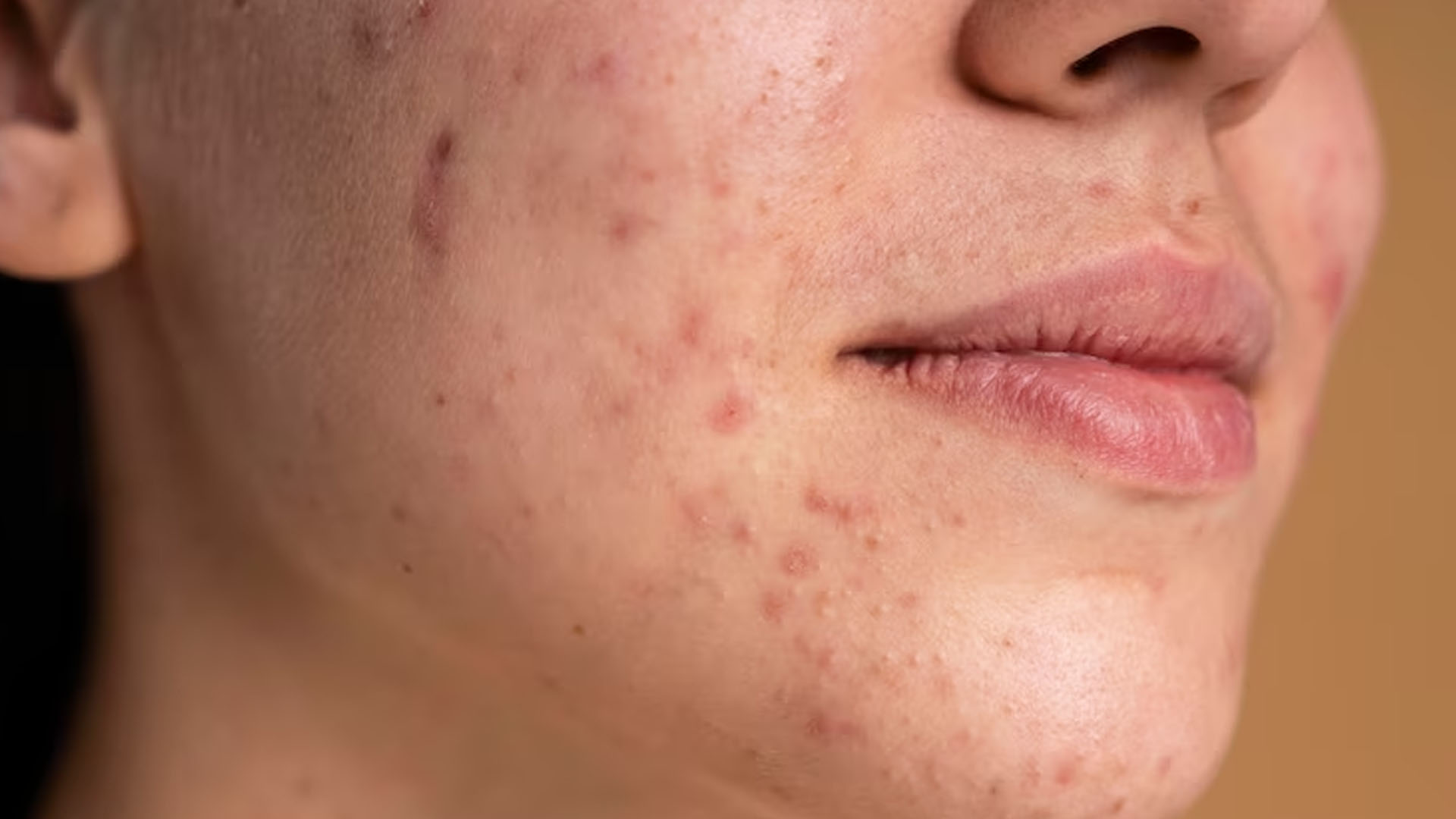 How Long does it take for Herpes Symptoms to Show?