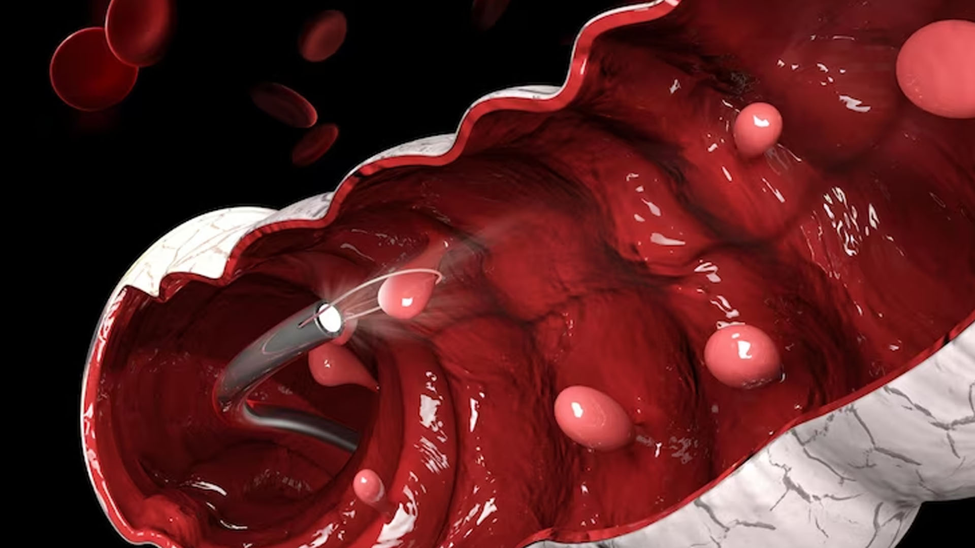 What are the Signs and Symptoms of Internal Bleeding?