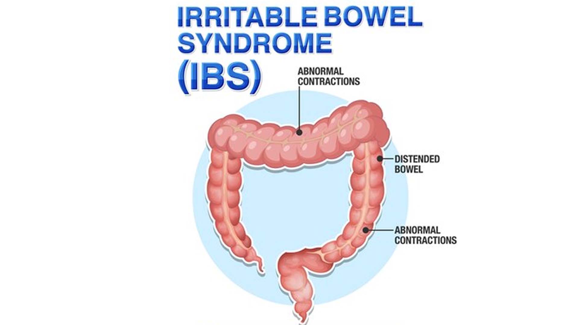 irritable bowel syndrome (IBS)