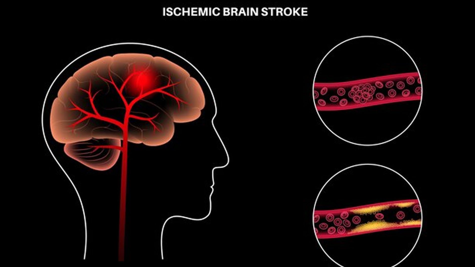 Ischemic Stroke