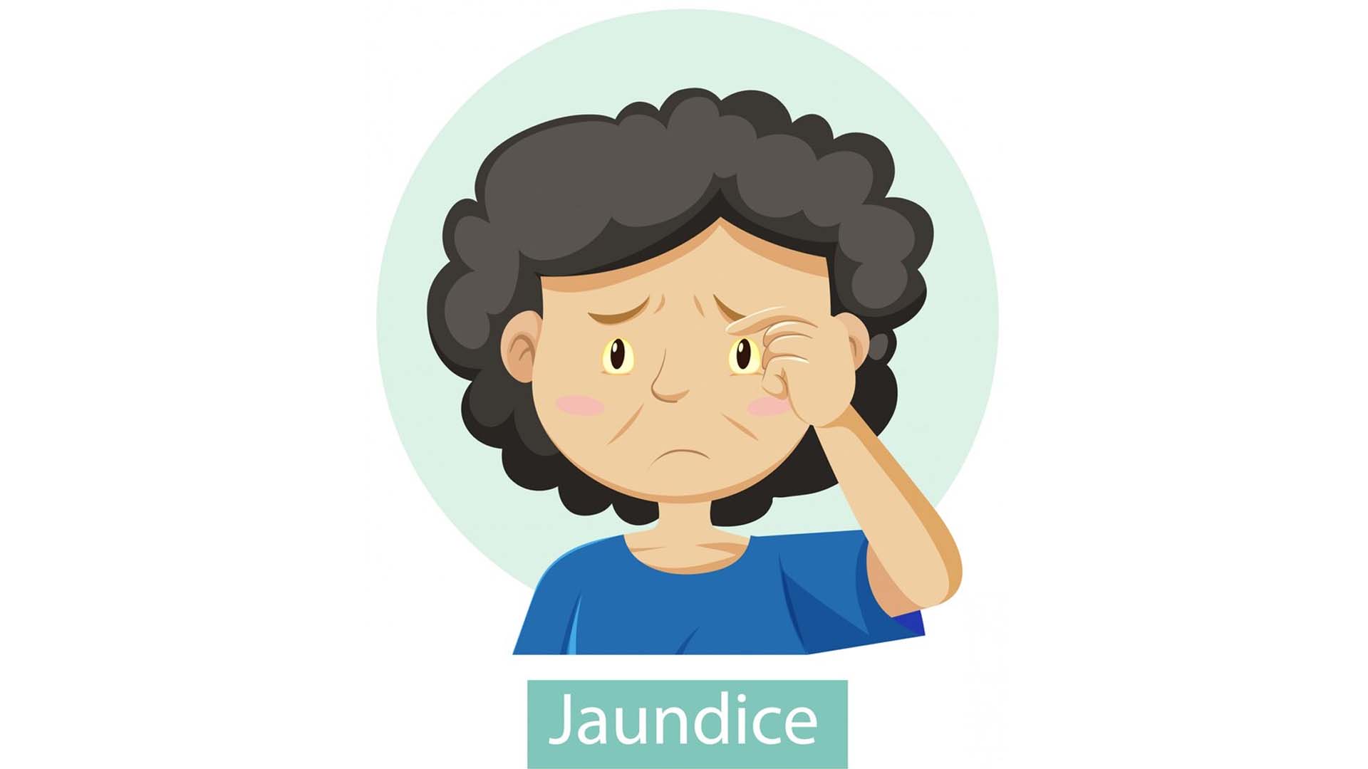 Jaundice
