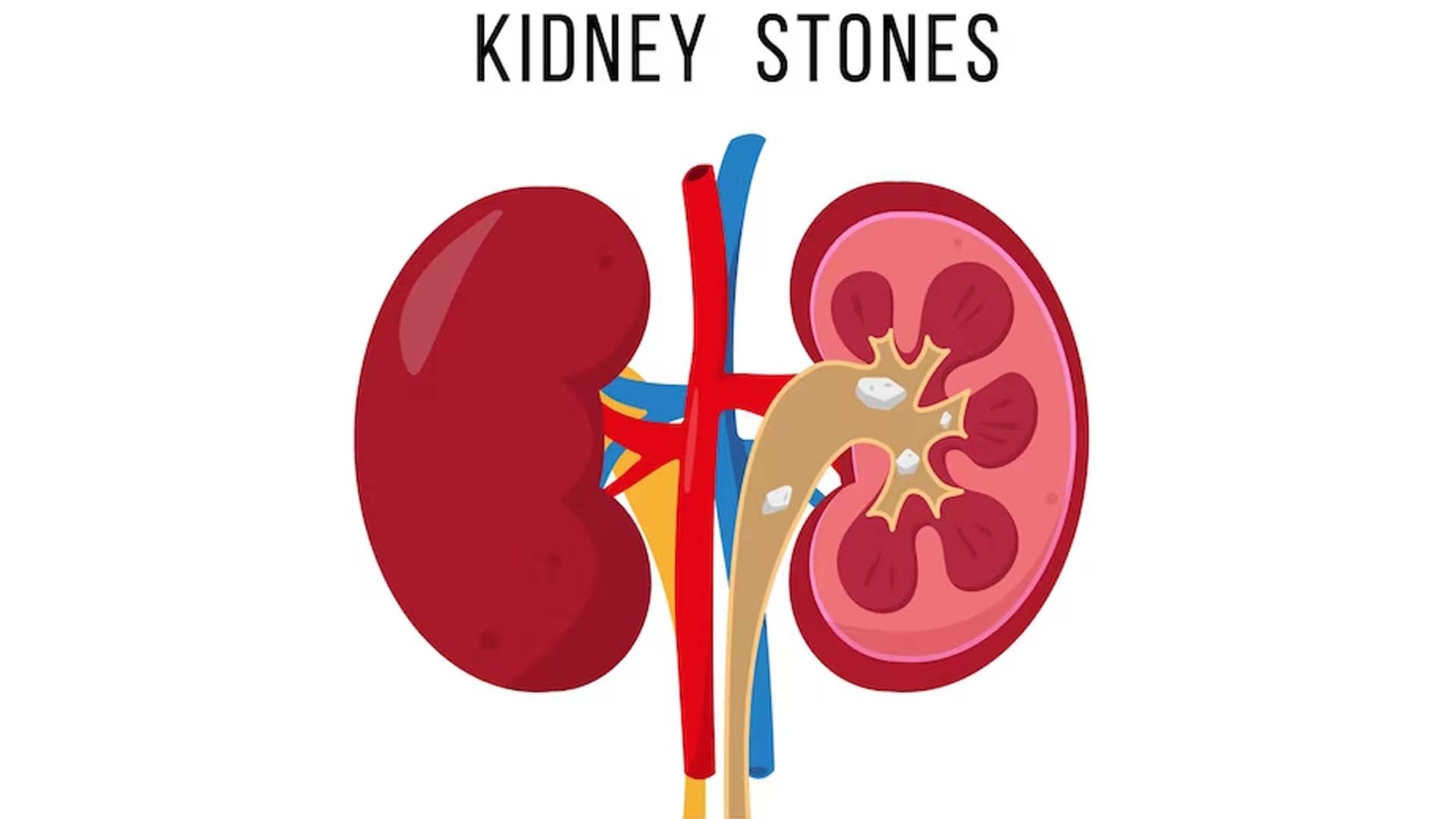 Kidney Stones Illustration