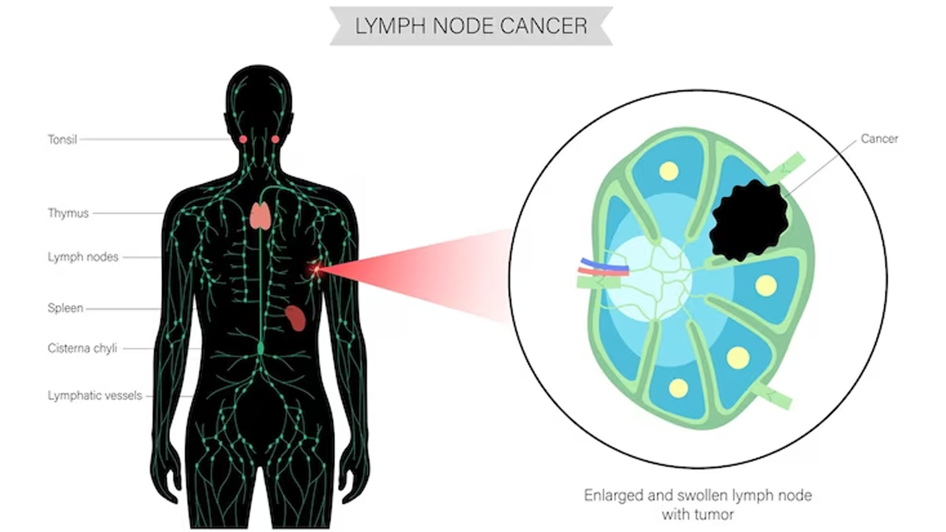 What are the Symptoms of Lymphoproliferative Disorder?
