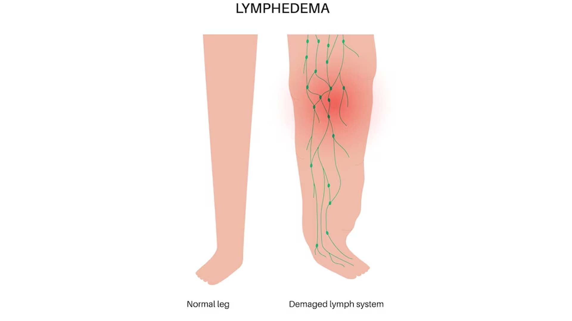 What Causes Lymphedema in the Legs? – NutritionFact.in