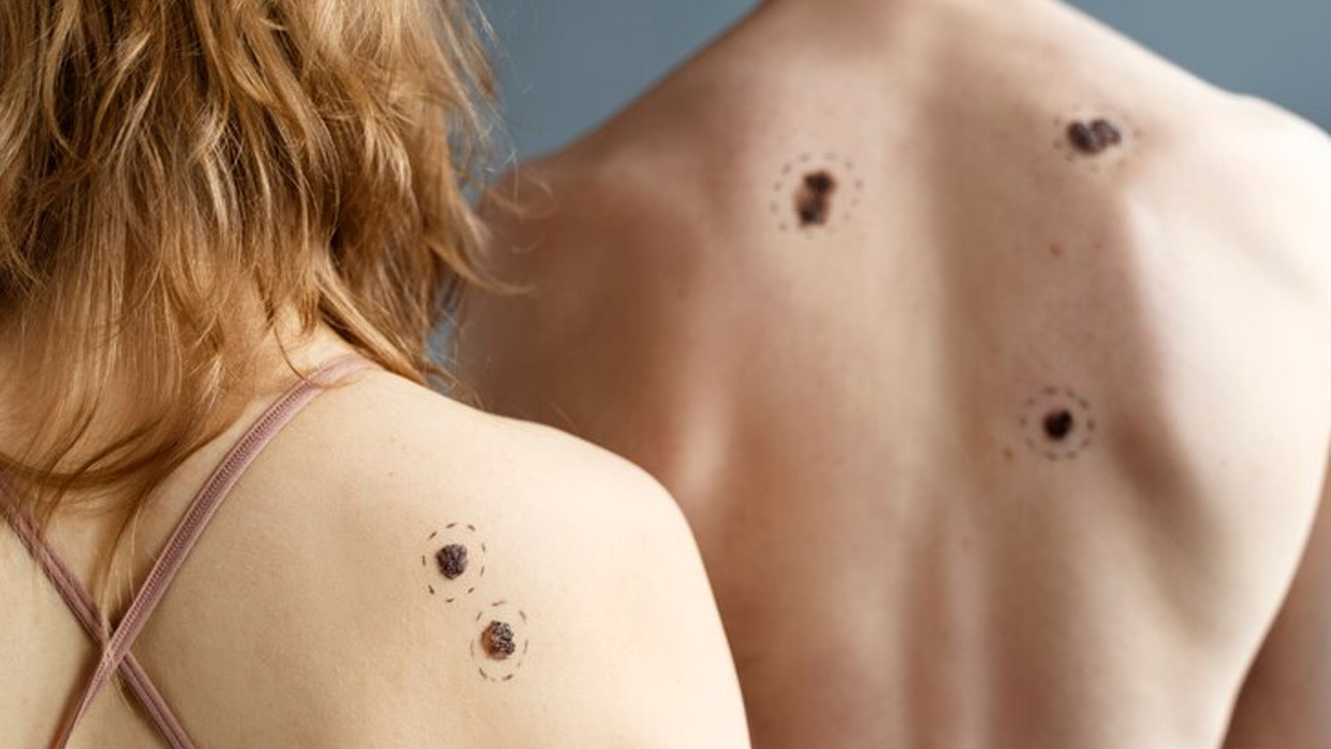 Does Melanoma Have Symptoms?