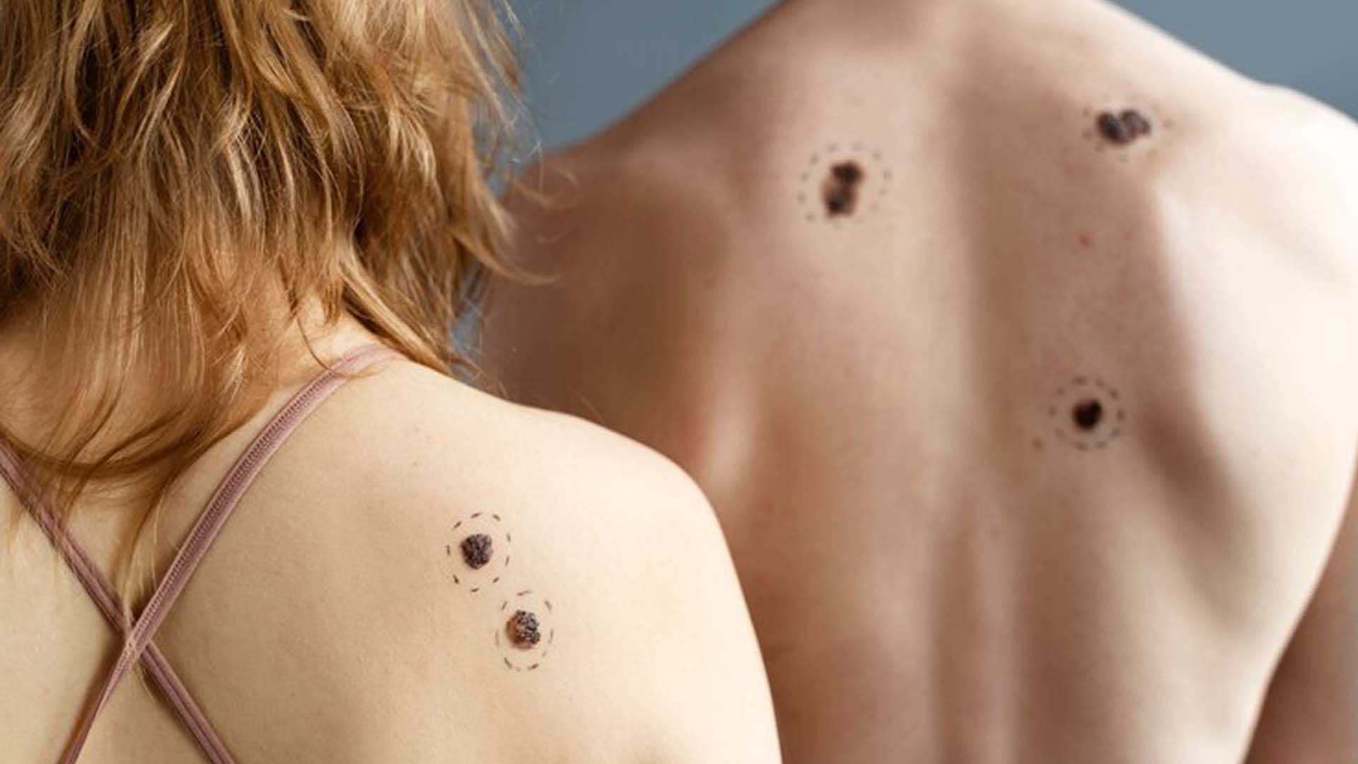Melanoma
