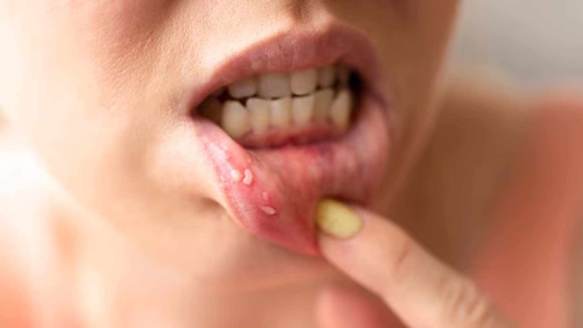 Women showing Mouth Ulcers