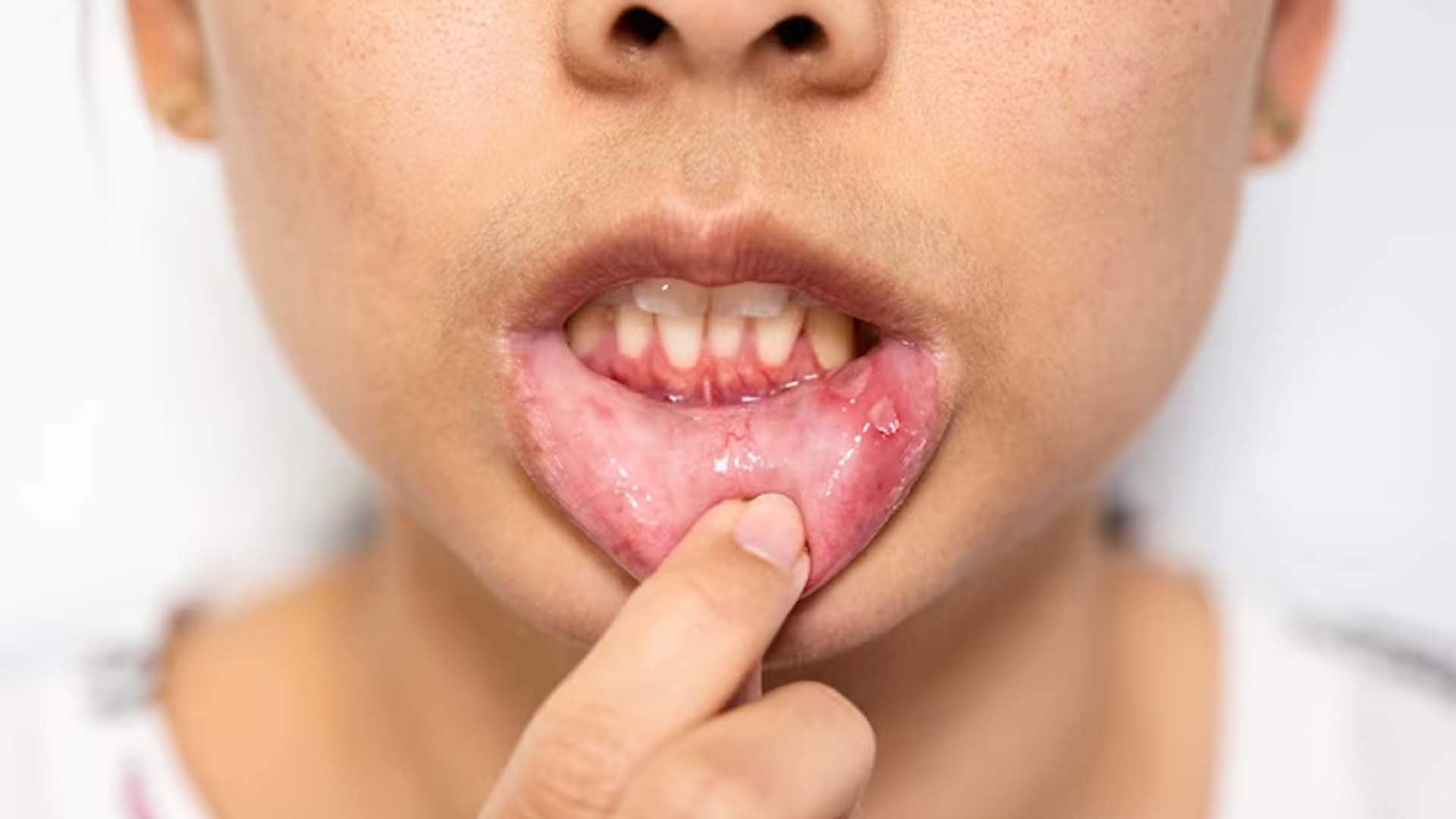 Mouth ulcers