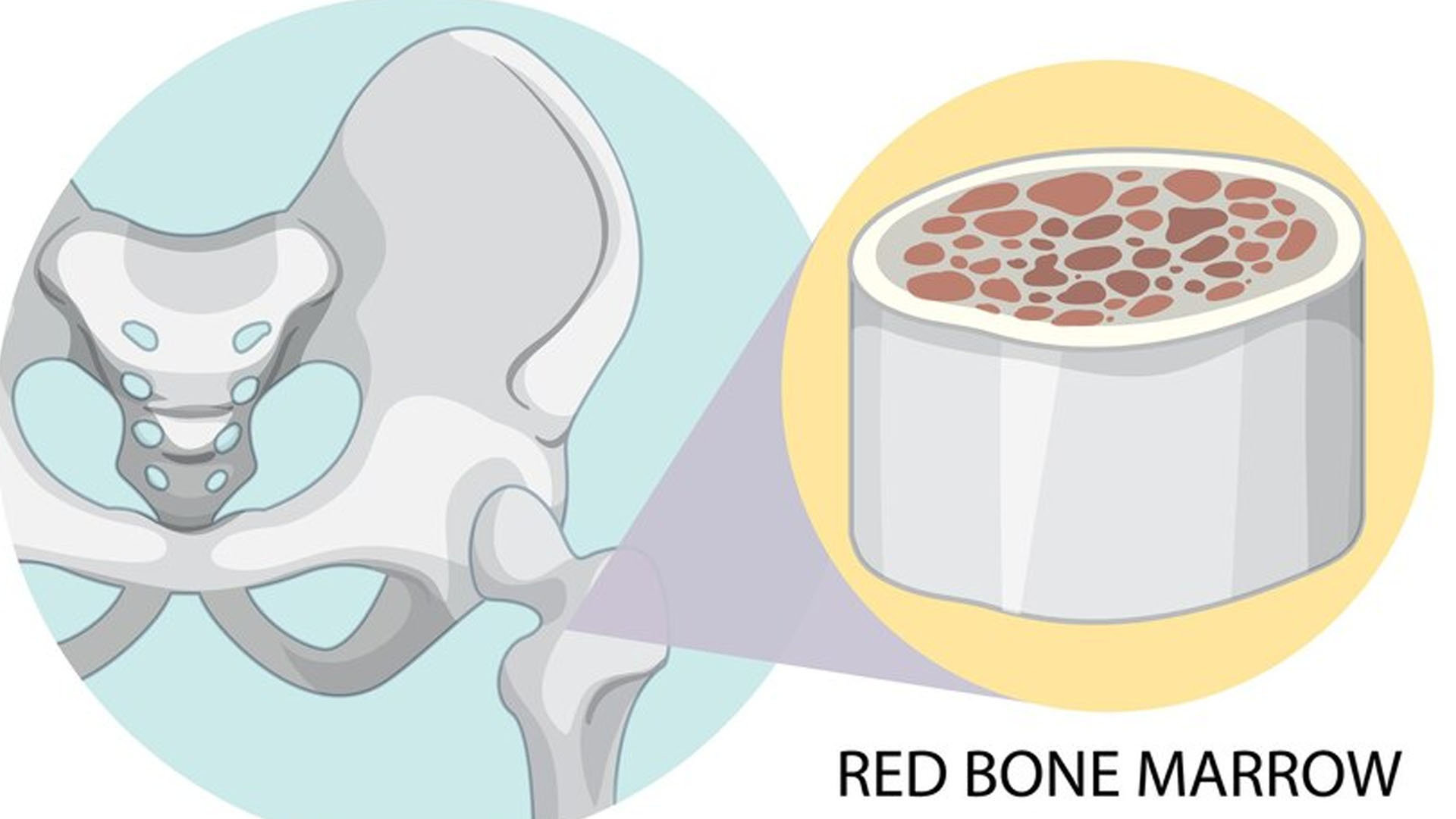What are the Symptoms of Dying from Myeloma?