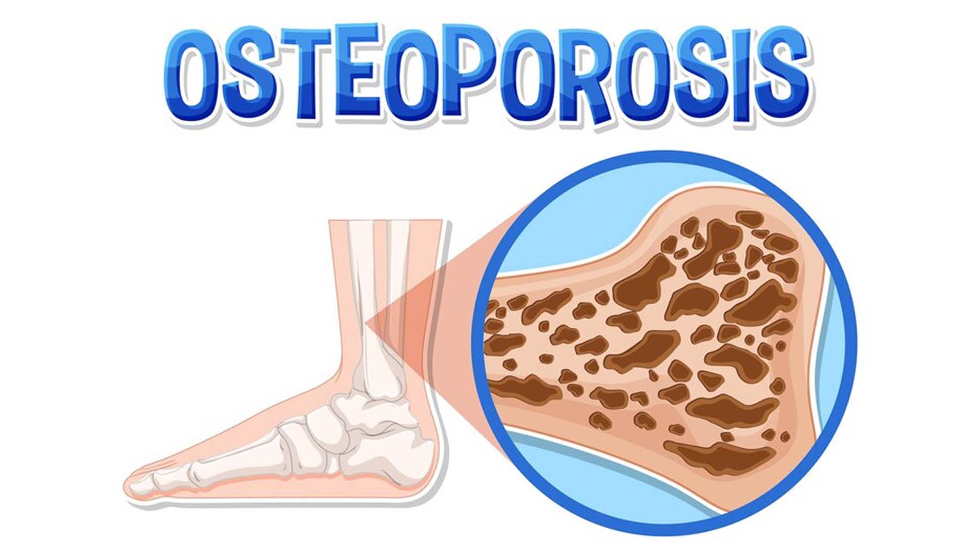 Osteoporosis