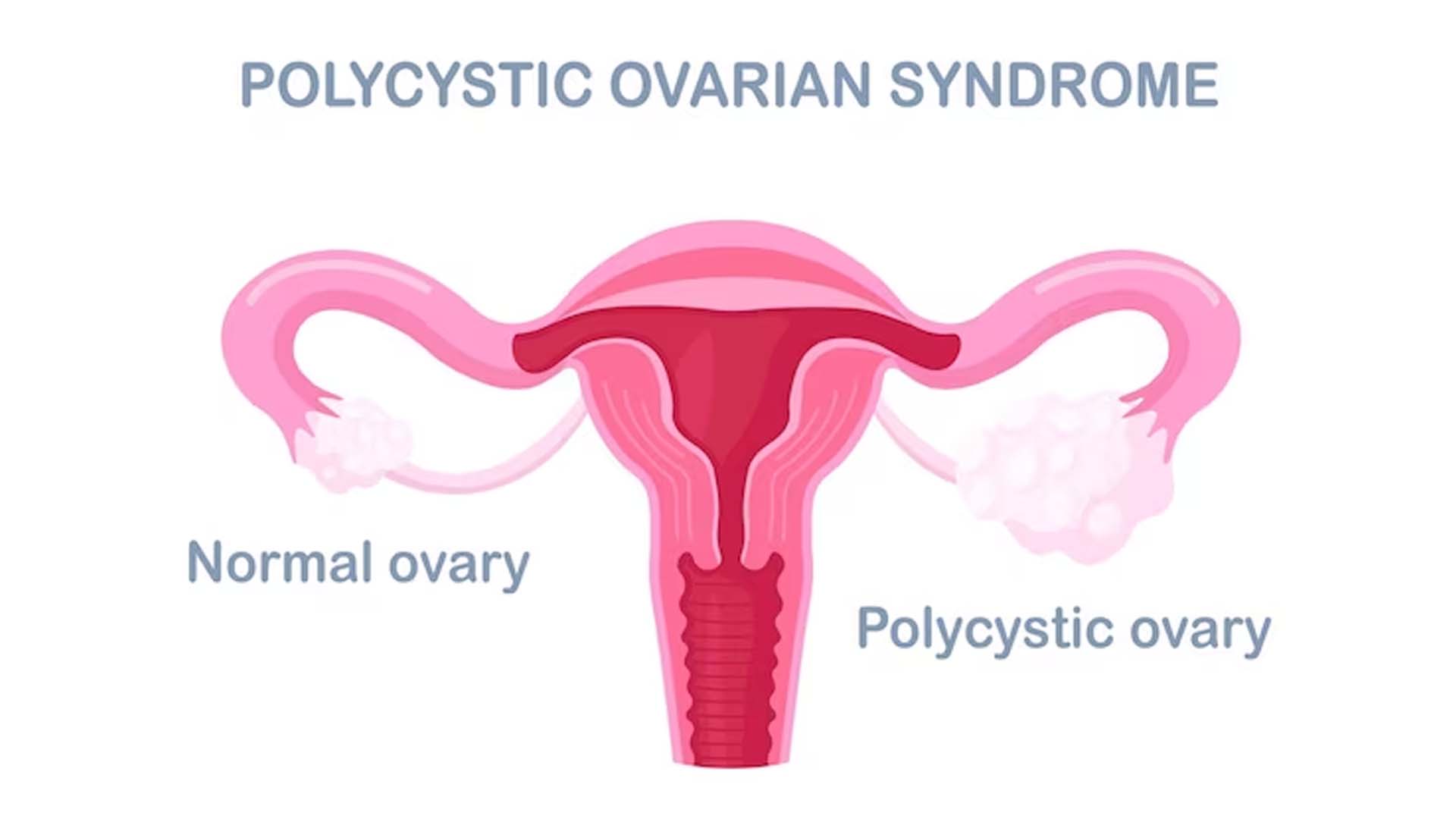Polycystic ovary syndrome (PCOS)