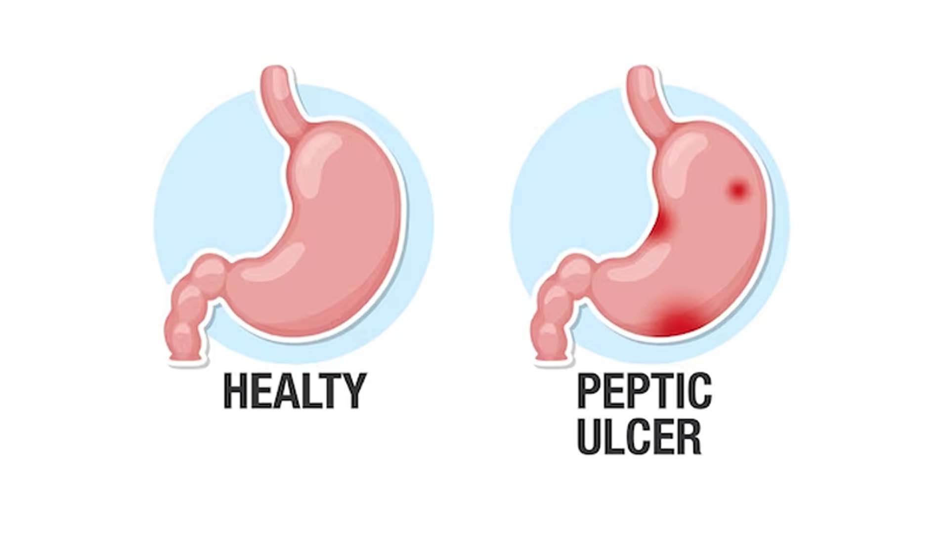 Ulcer