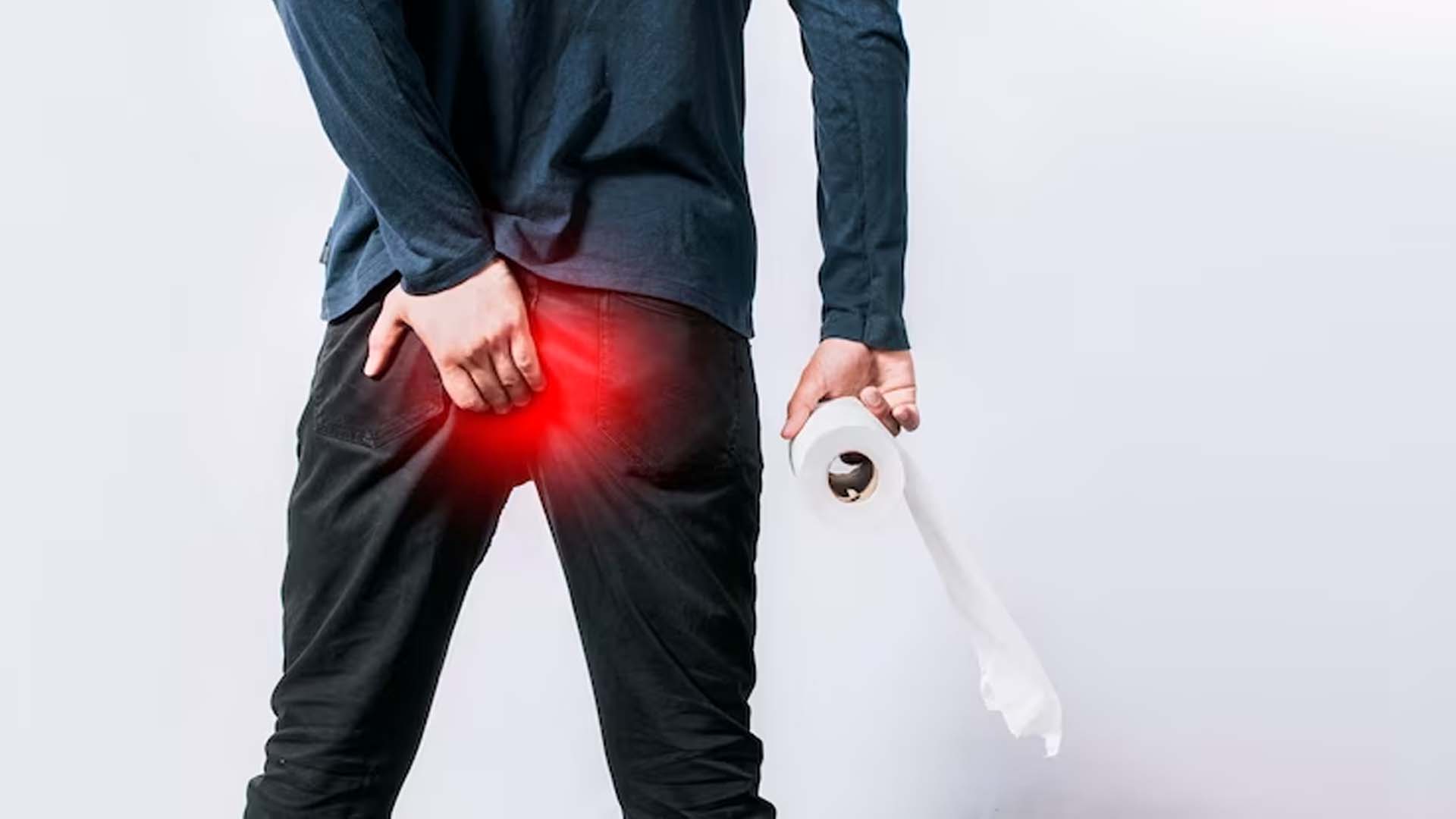 Hemorrhoids