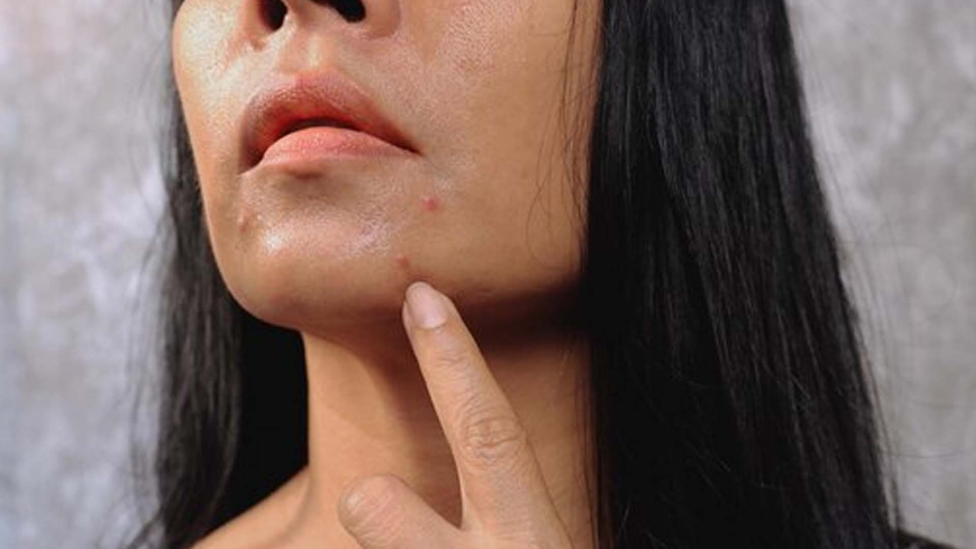 Pimples or acne on Chin