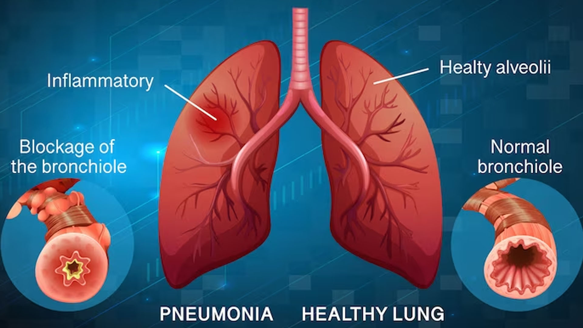 What are the Symptoms of Pneumonia in Newborns?