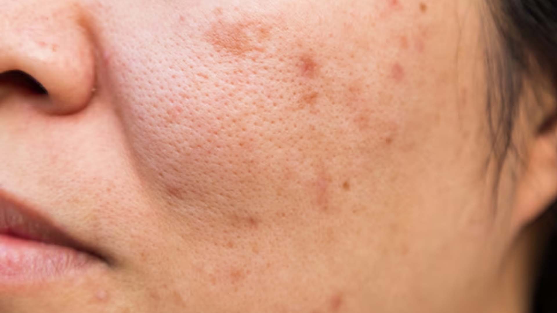 Women Having Pores on Face