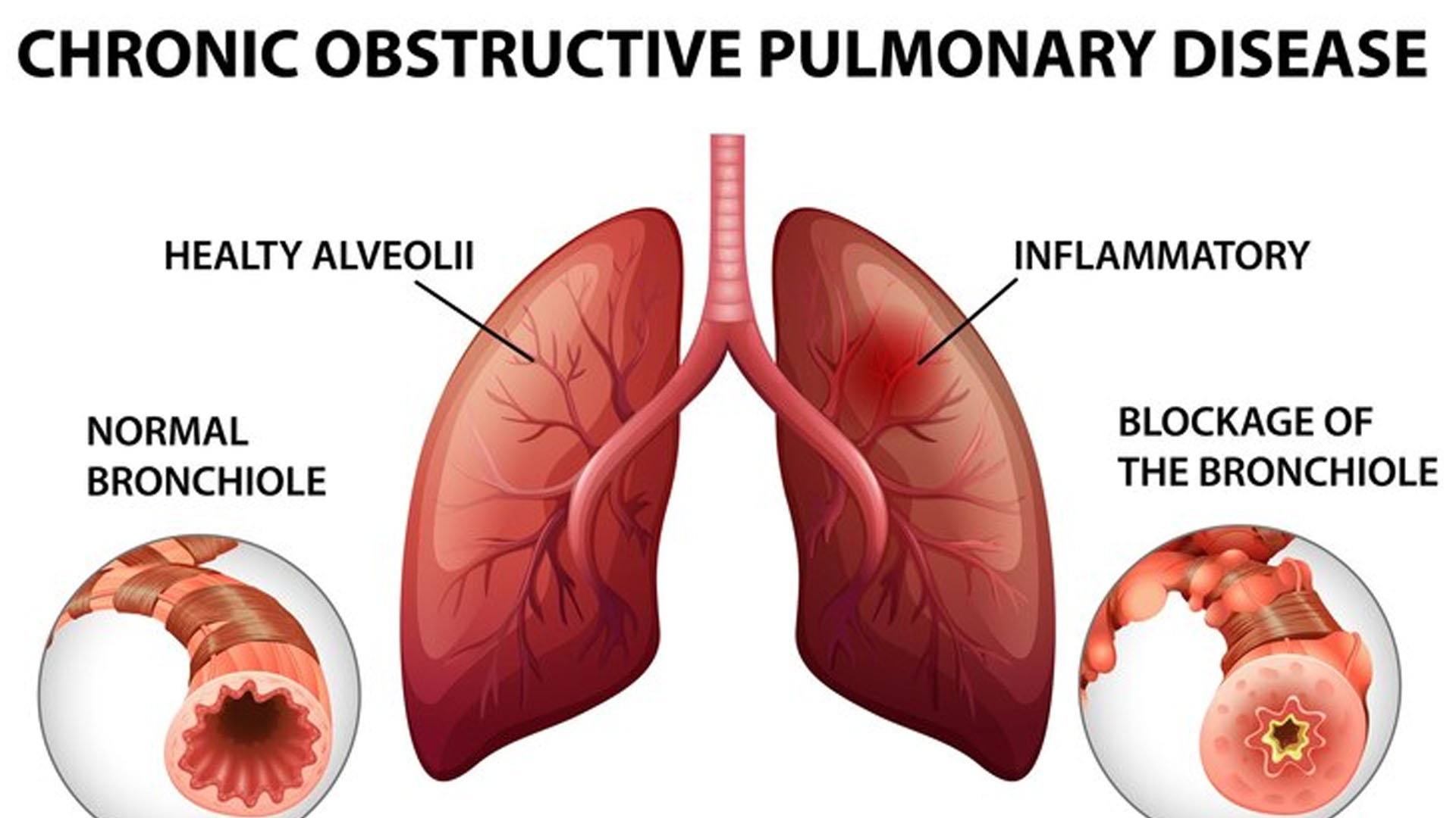 What are the Symptoms of Chronic Obstructive Pulmonary Disease?