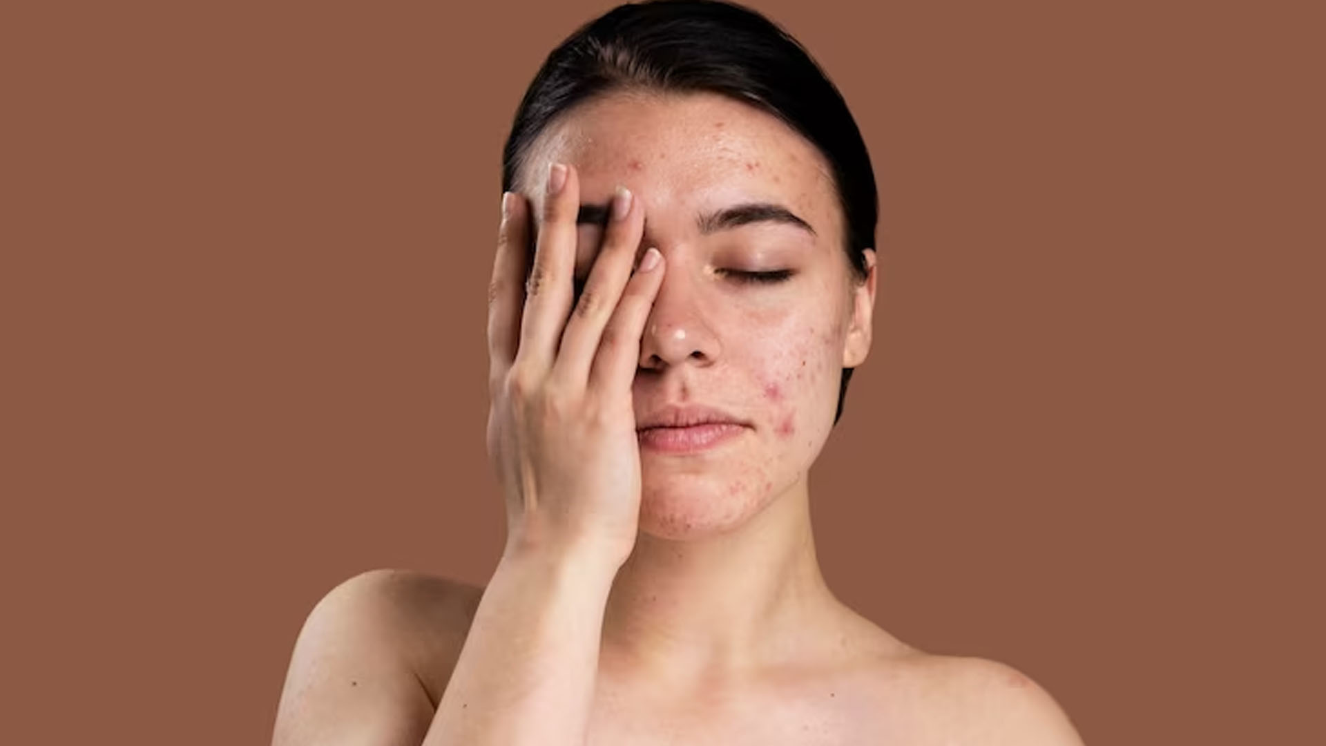 What is Scleroderma and its Symptoms?