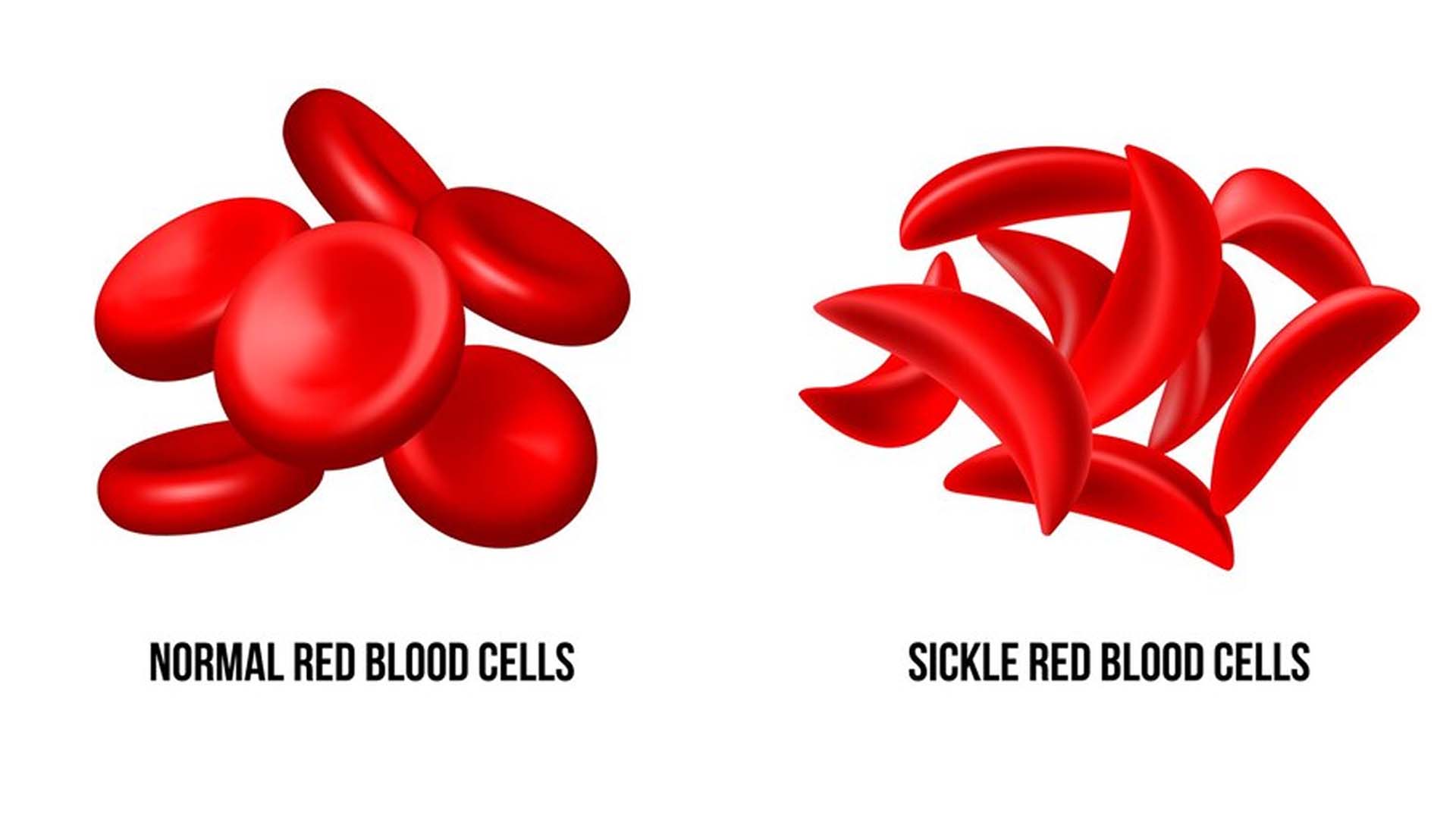 Sickle cell anemia