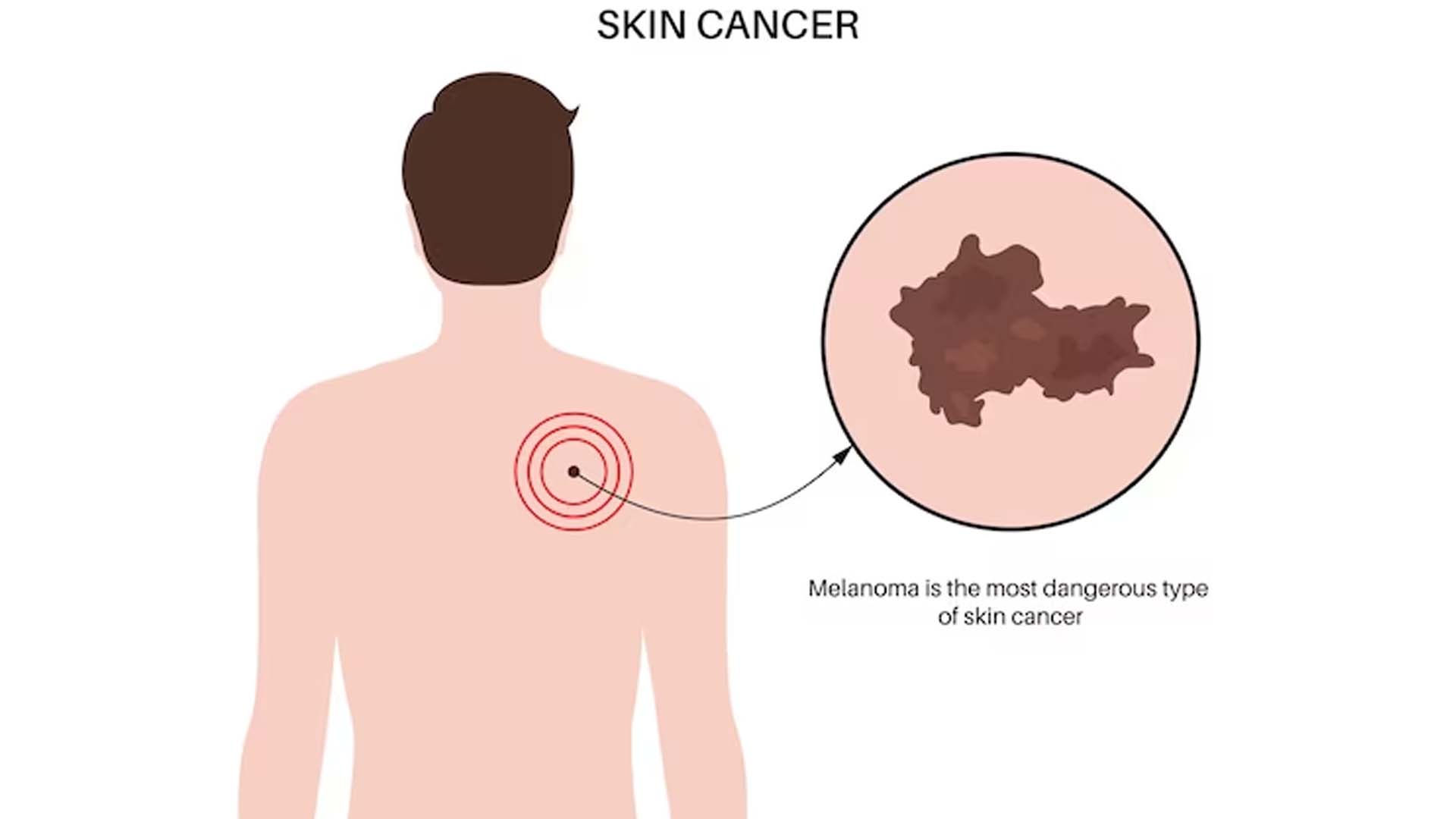 Skin Cancer or Melanoma